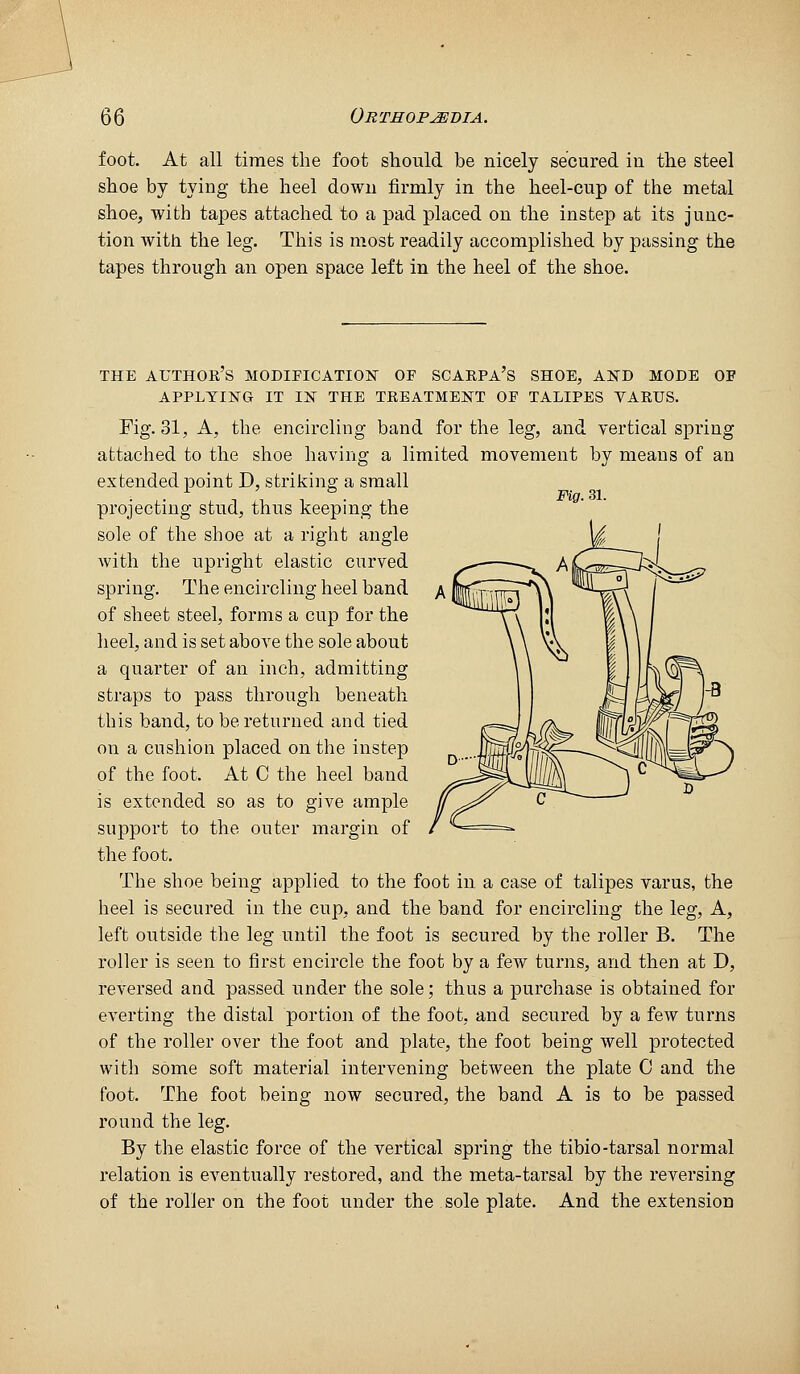 foot. At all times the foot should be nicely secured in the steel shoe by tying the heel down firmly in the heel-cup of the metal shoe, with tapes attached to a pad placed on the instep at its junc- tion with the leg. This is most readily accomplished by passing the tapes through an open space left in the heel of the shoe. THE AUTHOK'S modification OF SCAEPA'S SHOE, AND MODE OF APPLYING IT IN THE TKEATMENT OF TALIPES VARUS, Fig. 31, A, the encircling band for the leg, and vertical spring attached to the shoe having a limited movement bv means of an extended point D, striking a small projecting stud, thus keeping the sole of the shoe at a right angle with the upright elastic curved spring. The encircling heel band of sheet steel, forms a cup for the heel, and is set above the sole about a quarter of an inch, admitting straps to pass through beneath this band, to be returned and tied on a cushion placed on the instep of the foot. At C the heel band is extended so as to give ample support to the outer margin of the foot. The shoe being applied to the foot in a case of talipes varus, the heel is secured in the cup, and the band for encircling the leg, A, left outside the leg until the foot is secured by the roller B. The roller is seen to first encircle the foot by a few turns, and then at D, reversed and passed under the sole; thus a purchase is obtained for everting the distal portion of the foot, and secured by a few turns of the roller over the foot and plate, the foot being well protected with some soft material intervening between the plate 0 and the foot. The foot being now secured, the band A is to be passed round the leg. By the elastic force of the vertical spring the tibio-tarsal normal relation is eventually restored, and the meta-tarsal by the reversing of the roller on the foot under the sole plate. And the extension