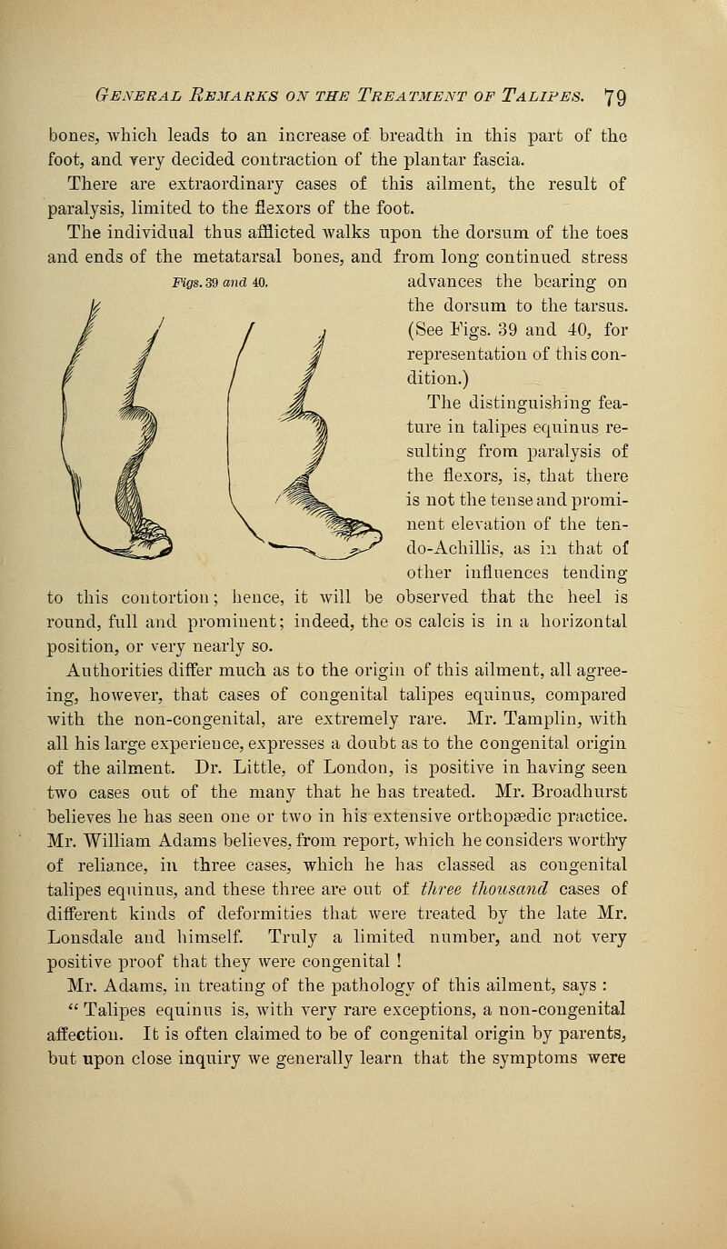 bones, which leads to an increase of breadth in this part of the foot, and yery decided contraction of the plantar fascia. There are extraordinary cases of this ailment, the result of paralysis, limited to the flexors of the foot. The individual thus afflicted walks upon the dorsum of the toes and ends of the metatarsal bones, and from long continued stress Mqs. 39 and 40. advances the bearing on the dorsum to the tarsus. (See Figs. 39 and 40, for representation of this con- dition.) The distinguishing fea- ture in talipes equinus re- sulting from paralysis of the flexors, is, that there is not the tense and promi- nent elevation of the ten- do-Achillis, as in that of other influences tending to this contortion; hence, it will be observed that the heel is round, full and prominent; indeed, the os calcis is in a horizontal position, or very nearly so. Authorities differ much as to the origin of this ailment, all agree- ing, however, that cases of congenital talipes equinus, compared with the non-congenital, are extremely rare. Mr. Tamplin, with all his large experience, expresses a doubt as to the congenital origin of the ailment. Dr. Little, of London, is positive in having seen two cases out of the many that he has treated. Mr. Broadhurst believes he has seen one or two in his extensive orthopedic practice. Mr. William Adams believes, from report, which he considers worthy of reliajice, in three cases, which he has classed as congenital talipes equinus, and these three are out of three thousand cases of different kinds of deformities that were treated by the late Mr. Lonsdale and himself. Truly a limited number, and not very positive proof that they were congenital ! Mr. Adams, in treating of the pathology of this ailment, says :  Talipes equinus is, with very rare exceptions, a non-congenital affection. It is often claimed to be of congenital origin by parents, but upon close inquiry we generally learn that the symptoms were