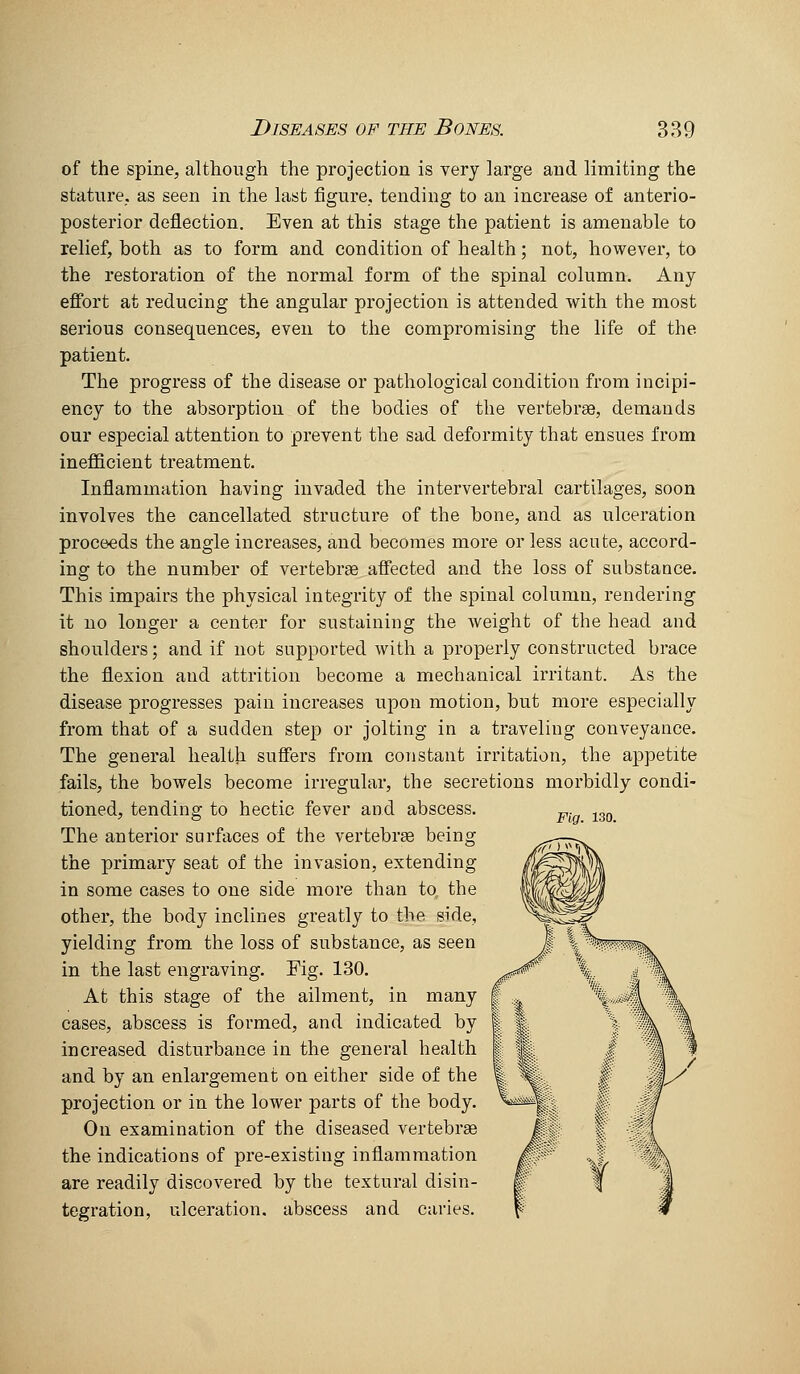 of the spine, although the projection is very large and limiting the stature, as seen in the last figure., tending to an increase of anterio- posterior deflection. Even at this stage the patient is amenable to relief, both as to form and condition of health; not, however, to the restoration of the normal form of the spinal column. Any effort at reducing the angular projection is attended with the most serious consequences, even to the compromising the life of the patient. The progress of the disease or pathological condition from incipi- ency to the absorption of the bodies of the vertebrse, demands our especial attention to prevent the sad deformity that ensues from inefficient treatment. Inflammation having invaded the intervertebral cartilages, soon involves the cancellated structure of the bone, and as ulceration proceeds the angle increases, and becomes more or less acute, accord- ing to the number of vertebrae affected and the loss of substance. This impairs the physical integrity of the spinal column, rendering it no longer a center for sustaining the weight of the head and shoulders; and if not supported with a properly constructed brace the flexion and attrition become a mechanical irritant. As the disease progresses pain increases upon motion, but more especially from that of a sudden step or jolting in a traveling conveyance. The general health suffers from constant irritation, the appetite fails, the bowels become irregular, the secretions morbidly condi- tioned, tending to hectic fever and abscess. The anterior surfaces of the vertebrse being the primary seat of the invasion, extending in some cases to one side more than to the other, the body inclines greatly to the side, yielding from the loss of substance, as seen in the last engraving. Fig. 130. At this stage of the ailment, in many cases, abscess is formed, and indicated by increased disturbance in the general health and by an enlargement on either side of the projection or in the lower parts of the body. On examination of the diseased vertebrae the indications of pre-existing inflammation are readily discovered by the textural disin- tegration, ulceration, abscess and caries. Fig. 130.