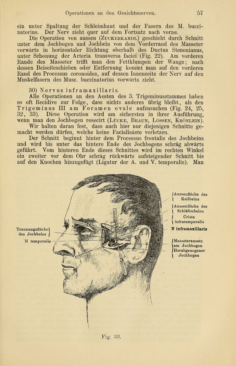 ein unter Spaltung der Schleimhaut und der Fasern des M. bucci- natorius. Der Nerv zieht quer auf dem Fortsatz nach vorne. Die Operation von aussen (Zuckeekandl) geschieht durch Schnitt unter dem Jochbogen und Jochbein von dem Vorderrand des Masseter vorwärts in horizontaler Richtung oberhalb des Ductus Stenonianus, unter Schonung der Arteria transversa faciei (Fig. 22). Am vorderen Rande des Masseter trifft man den Fettklumpen der Wange; nach dessen Beiseiteschieben oder Entfernung kommt man auf den vorderen Rand des Processus coronoides, auf dessen Innenseite der Nerv auf den Muskelfasern des Muse, buccinatorius vorwärts zieht. 30) Nervus inframaxillaris. Alle Operationen an den Aesten des 3. Trigeminusstammes haben so oft Recidive zur Folge, dass nichts anderes übrig bleibt, als den Trigeminus III am Foramen ovale aufzusuchen (Fig. 24, 25, 32, 33). Diese Operation wird am sichersten in ihrer Ausführung, wenn man den Jochbogen resecirt (Lücke, Beaun, Lossen, Keönlein). Wir halten daran fest, dass auch hier nur diejenigen Schnitte ge- macht werden dürfen, welche keine Facialisäste verletzen. Der Schnitt beginnt hinter dem Processus frontalis des Jochbeins und wird bis unter das hintere Ende des Jochbogens schräg abwärts geführt. Vom hinteren Ende dieses Schnittes wird im rechten Winkel ein zweiter vor dem Ohr schräg rückwärts aufsteigender Schnitt bis auf den Knochen hinzugefügt (Ligatur der A. und V. temporalis). Man Trennungsfläche des Jochbeins M temporalis /Aussenfläche des \ Keilbeins /Aussenfläche des ^ Schläfenbeins f Crista \ infratemporalis N inframaxillaris /Masseteransatz lam Jochbogen /Herabgezogener \ Jochbogen