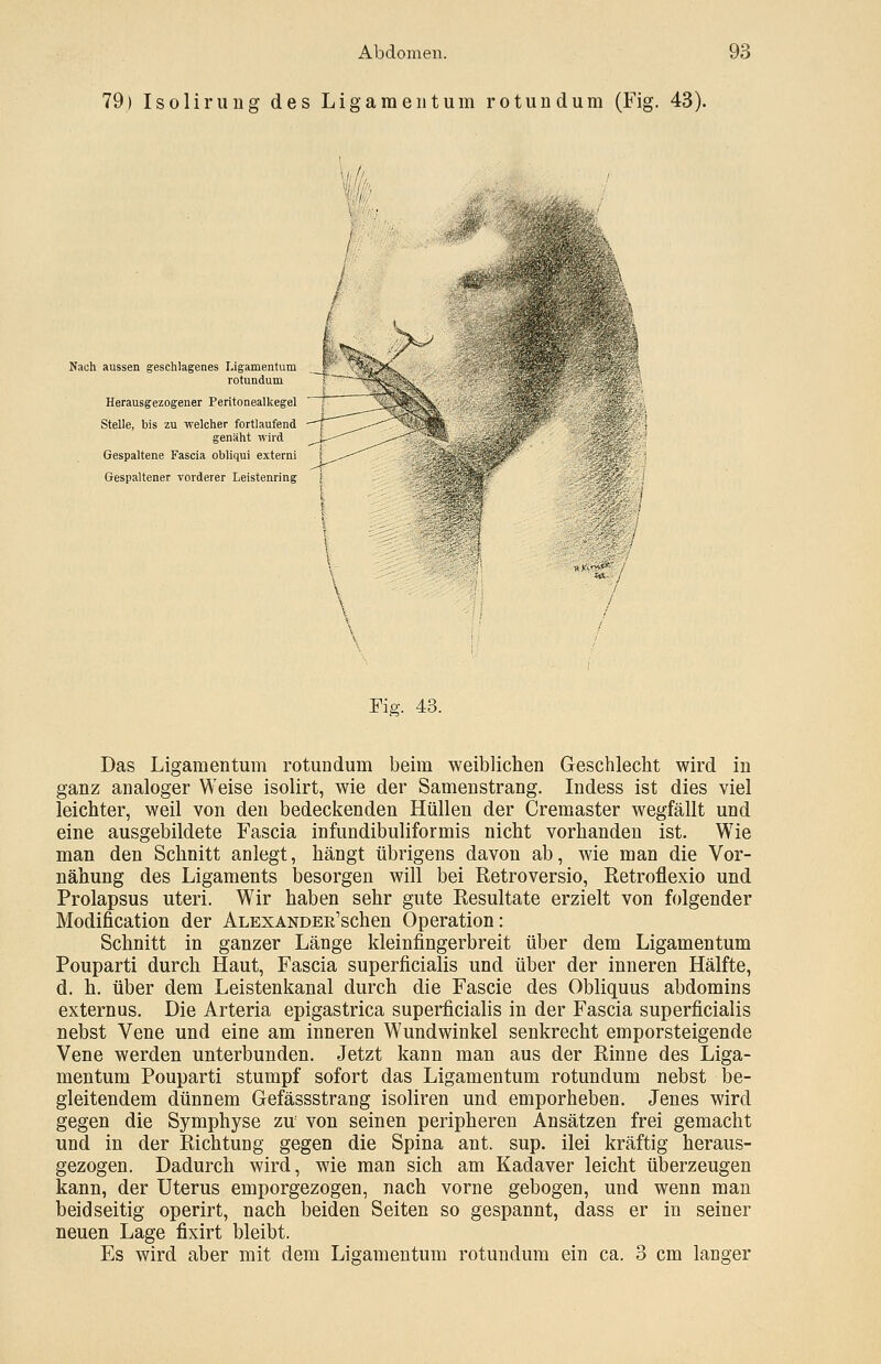 79) Isolirung des Ligamentum rotundum (Fig. 43). ' Nach aussen geschlagenes Ligamentum rotundum Herausgezogener Peritonealkegel Stelle, bis zu -welcher fortlaufend genäht wird Gespaltene Fascia obliqui externi Gespaltener vorderer Leistenring Fig. 43. Das Ligamentum rotundum beim weiblichen Geschlecht wird in ganz analoger Weise isolirt, wie der Samenstrang. Indess ist dies viel leichter, weil von den bedeckenden Hüllen der Cremaster wegfällt und eine ausgebildete Fascia infundibuliformis nicht vorhanden ist. Wie man den Schnitt anlegt, hängt übrigens davon ab, wie man die Vor- nähung des Ligaments besorgen will bei Retroversio, Retroflexio und Prolapsus uteri. Wir haben sehr gute Resultate erzielt von folgender Modifikation der ALEXANDER'schen Operation: Schnitt in ganzer Länge kleinfingerbreit über dem Ligamentum Pouparti durch Haut, Fascia superficialis und über der inneren Hälfte, d. h. über dem Leistenkanal durch die Fascie des Obliquus abdomins externus. Die Arteria epigastrica superficialis in der Fascia superficialis nebst Vene und eine am inneren Wundwinkel senkrecht emporsteigende Vene werden unterbunden. Jetzt kann man aus der Rinne des Liga- mentum Pouparti stumpf sofort das Ligamentum rotundum nebst be- gleitendem dünnem Gefässstrang isoliren und emporheben. Jenes wird gegen die Symphyse zu von seinen peripheren Ansätzen frei gemacht und in der Richtung gegen die Spina ant. sup. ilei kräftig heraus- gezogen. Dadurch wird, wie man sich am Kadaver leicht überzeugen kann, der Uterus emporgezogen, nach vorne gebogen, und wenn man beidseitig operirt, nach beiden Seiten so gespannt, dass er in seiner neuen Lage fixirt bleibt. Es wird aber mit dem Ligamentum rotundum ein ca. 3 cm langer