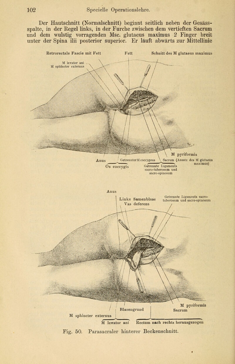 Der Hautschnitt (Normalschnitt) beginnt seitlich neben der Gesäss- spalte, in der Regel links, in der Furche zwischen dem vertieften Sacrum und dem wulstig vorragenden Msc. glutaeus maximus 2 Finger breit unter der Spina ilii posterior superior. Er läuft abwärts zur Mittellinie Retrorectale Fascie mit Fett M levator ani M sphincter externus Schnitt des M glutaeus maximus ^ \ \ M pyriformis Anus Getrennter Mcoccygeus \ Sacrum (Ansatz des M glutaeus Os COCCVgis Getrennte Ligamenta sacro-tuberosum und sacro-spiiiosum maximus) . _ Getrennte Ligamenta sacro- Liinke oamenolase tuberosum und sacro-spinosum , Vas deferens / z7 / | Blasengrund M sphincter externus | M levator ani Rectum nach rechts herausgezogen Fig. 50. Parasacraler hinterer Beckenschnitt.