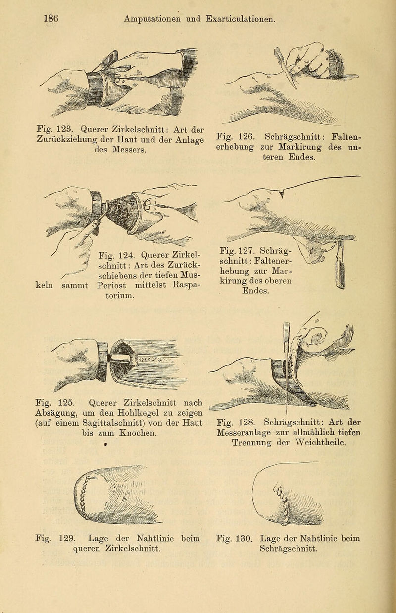 Fig. 123. Querer Zirkelschnitt: Art der Zurückziehung der Haut und der Anlage des Messers. Fig. 126. Schrägschnitt: Falten- erhebung zur Markirung des un- teren Endes. kein M Fig. 124. Querer Zirkel- jj schnitt: Art des Zurück- /■*** Schiebens der tiefen Mus- samint Periost mittelst Raspa- torium. Fig. 127. Schräg- schnitt : Faltener- hebung zur Mar- kirung des oberen Endes. Fig. 125. Querer Zirkelschnitt nach Absägung, um den Hohlkegel zu zeigen (auf einem Sagittalschnitt) von der Haut bis zum Knochen. Fig. 128. Schrägschnitt: Art der Messeranlage zur allmählich tiefen Trennung der Weichtheile. Fig. 129. Lage der Nahtlinie beim Fig. 130. Lage der Nahtlinie beim queren Zirkelschnitt. Schrägschnitt.