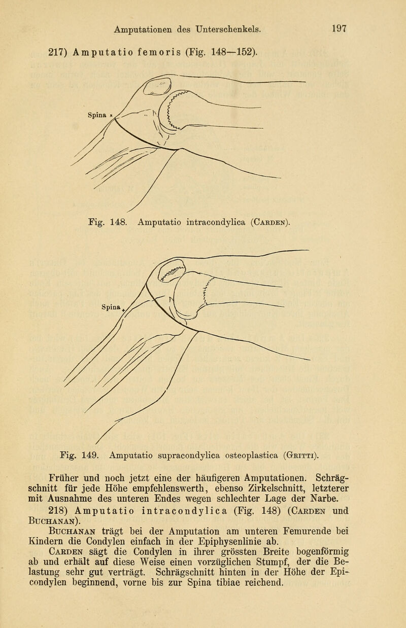 217) Amputatio femoris (Fig. 148—152). Fig. 148. Amputatio intracondylica (Caedbn). Amputatio supracondylica osteoplastica (Gtbitti). Früher und noch jetzt eine der häufigeren Amputationen. Schräg- schnitt für jede Höhe empfehlenswerth, ebenso Zirkelschnitt, letzterer mit Ausnahme des unteren Endes wegen schlechter Lage der Narbe. 218) Amputatio intracondylica (Fig. 148) (Cakden und Buchanan). Buchanan trägt bei der Amputation am unteren Femurende bei Kindern die Condylen einfach in der Epiphysenlinie ab. Caeden sägt die Condylen in ihrer grössten Breite bogenförmig ab und erhält auf diese Weise einen vorzüglichen Stumpf, der die Be- lastung sehr gut verträgt. Schrägschnitt hinten in der Höhe der Epi~ condylen beginnend, vorne bis zur Spina tibiae reichend.