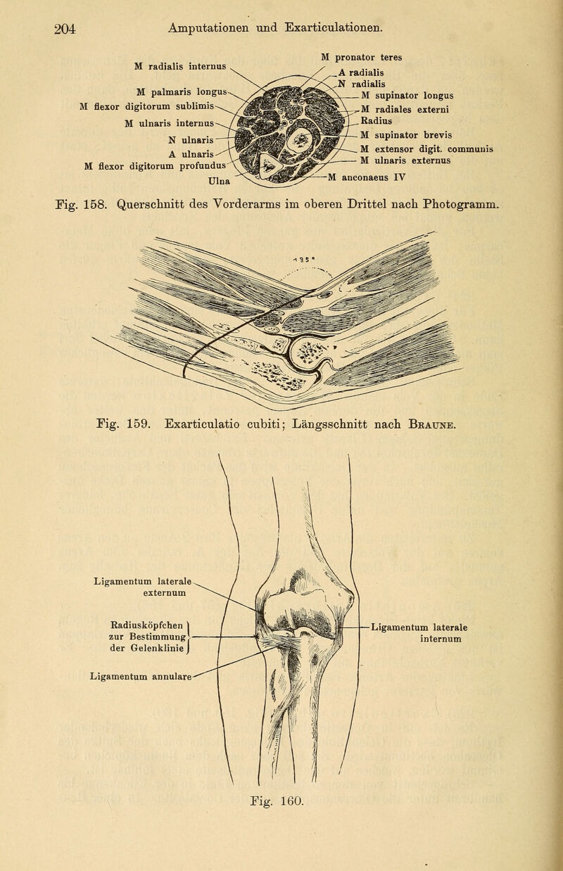 M radialis internus M palmaris longus M flexor digitorum sublimis M ulnaris internus N ulnaris A ulnaris M flexor digitorum profundus Ulna M pronator teres A radialis N radialis M supinator longus ,-M radiales externi Radius M supinator brevis M extensor digit. communis M ulnaris externus anconaeus IV Eig. 158. Querschnitt des Vorderarms im oberen Drittel nach Photogramm. Fig. 159. Exarticulatio cubiti; Längsschnitt nach Braune. Ligamentum laterale externum Radiusköpfchen zur Bestimmung der Gelenklinie Ligamentum annulare Ligamentum laterale internum Eig. 160.