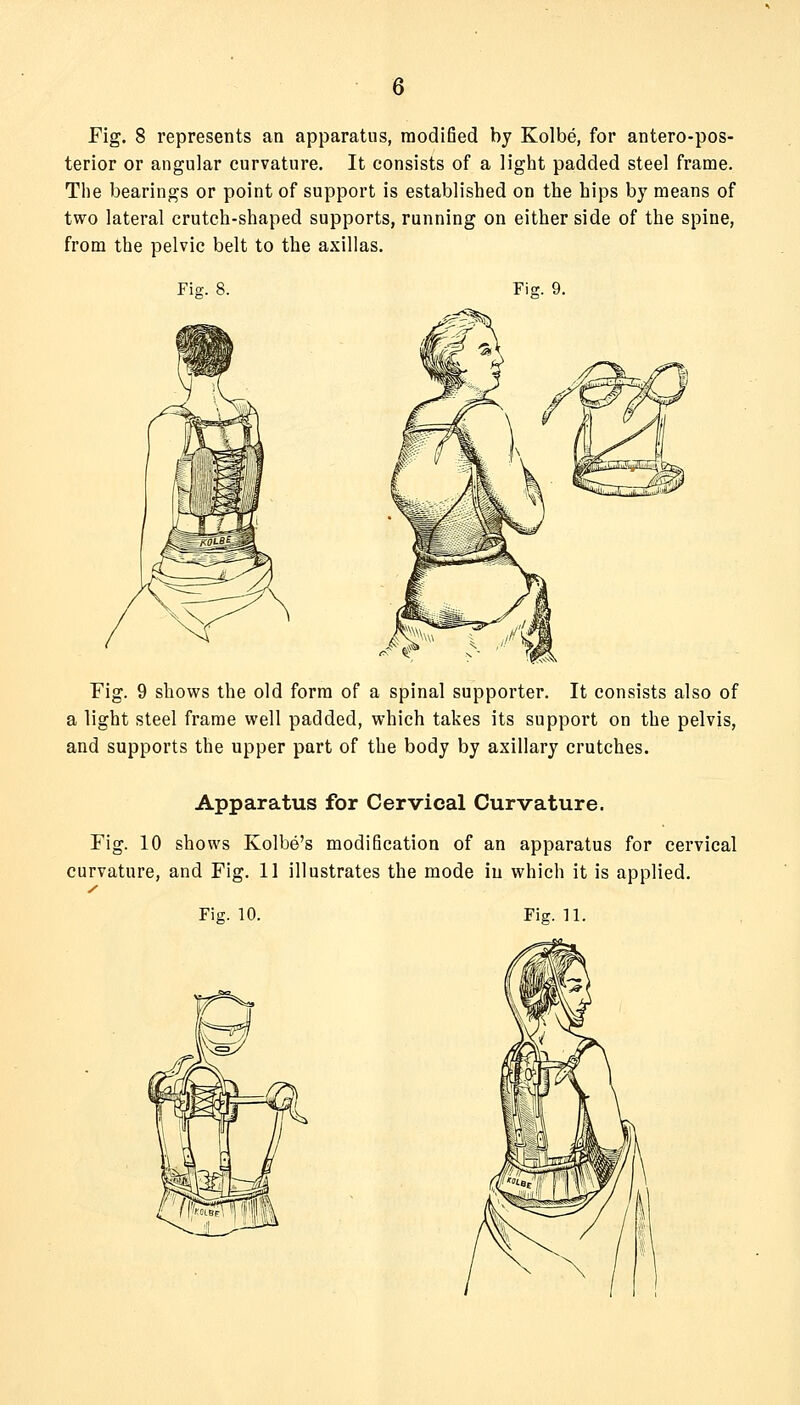 6 Fig. 8 represents an apparatus, modified by Kolbe, for antero-pos- terior or angular curvature. It consists of a light padded steel frame. The bearings or point of support is established on the hips by means of two lateral crutch-shaped supports, running on either side of the spine, from the pelvic belt to the axillas. Fig. 8. FiK. 9. Fig. 9 shovi^s the old form of a spinal supporter. It consists also of a light steel frame well padded, which takes its support on the pelvis, and supports the upper part of the body by axillary crutches. Apparatus for Cervical Curvature. Fig. 10 shows Kolbe's modification of an apparatus for cervical curvature, and Fig. 11 illustrates the mode in which it is applied.