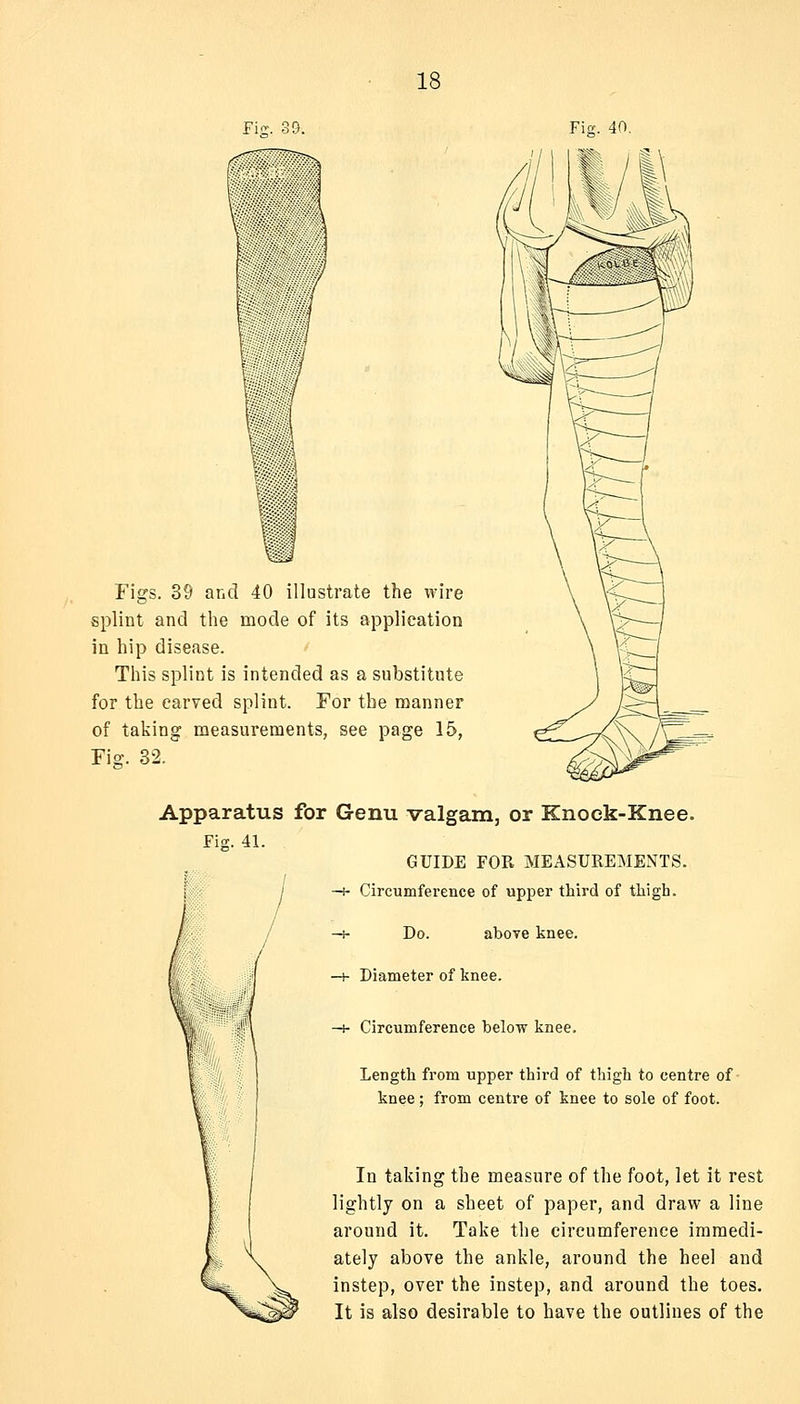 Fi<r. 39. Fig. 40, Figs. 39 and 40 illustrate the wire splint and the mode of its application in hip disease. This splint is intended as a substitute for the carved splint. For the manner of taking measurements, see page 15, Fiff. 32. Apparatus for Genu valgam, or Knock-Knee. Fig. 41. GUIDE FOR MEASUREMENTS. —H Circumference of upper third of tliigh. —i- Do. above knee. -+ Diameter of knee. —J- Circumference below knee. Length from upper third of thigh to centre of knee; from centre of knee to sole of foot. In taking the measure of the foot, let it rest lightly on a sheet of paper, and draw a line around it. Take the circumference immedi- ately above the ankle, around the heel and instep, over the instep, and around the toes. It is also desirable to have the outlines of the