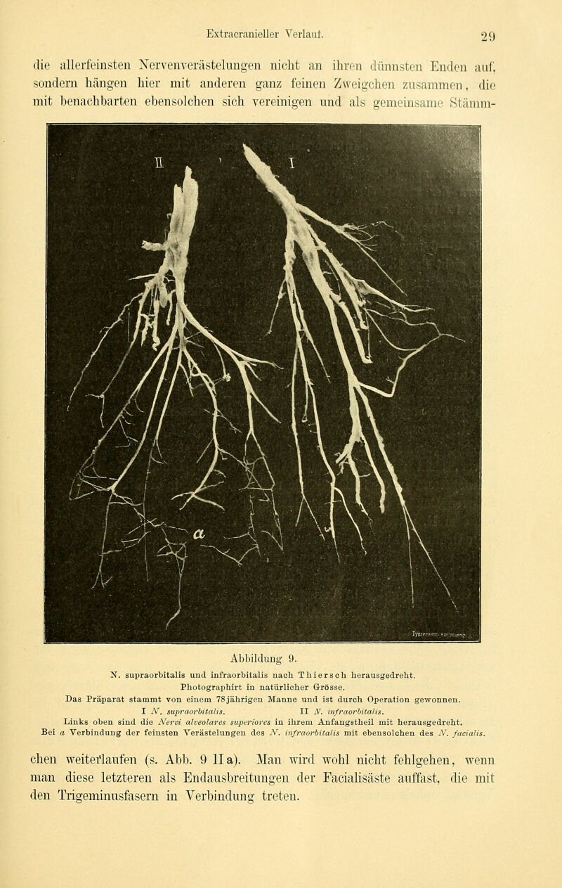 die allerfeinsten Nervenverästelungen nicht an ihren dünnsten Enden auf, sondern hängen hier mit anderen ganz feinen Zweigchen zusammen, die mit benachbarten ebensolchen sich vereinigen und als gemeinsame Stamm- Abbildung 9. N. supraorbitalis und infraorbitalis nach Thiersch herausgedreht. Photographirt in natürlicher Grösse. Das Präparat stammt von einem 78jährigen Manne und ist durch Operation gewonnen. I N'. supraorbitalis. II N. infraorbitalis. Links oben sind die Nervi alveolares superiores in ihrem Anfangstheil mit herausgedreht. Bei a Verbindung der feinsten Verästelungen des N. infraorbitalis mit ebensolchen des iV. facialis. chen weiteflaufen (s. Abb. 9 IIa). Mau wird wohl nicht fehlgehen, wenn man diese letzteren als Endausbreitungen der Faciahsäste auffast, die mit den Trigeminusfasern in Verbinduno- treten.