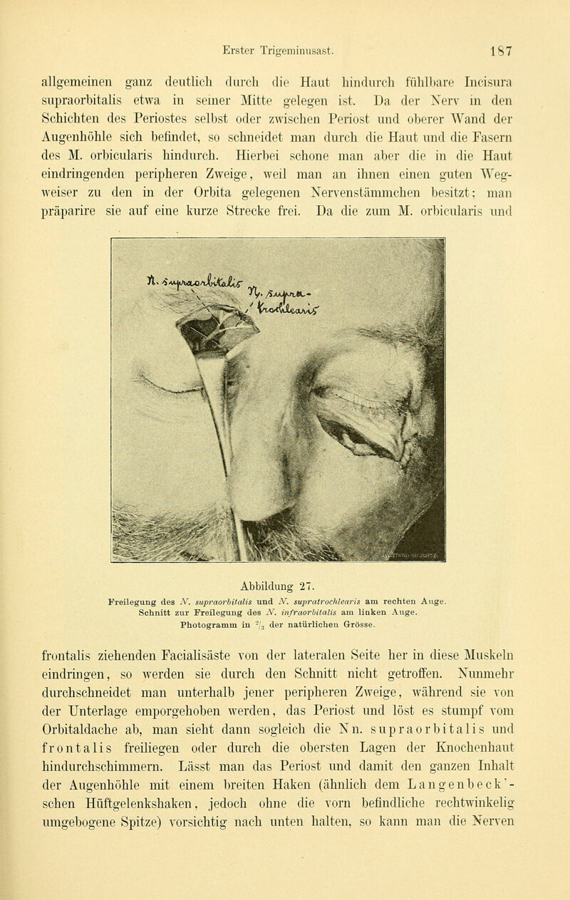 allgemeinen ganz deutlich durch die Haut hindurch fühll)are Incisura supraorhitalis etwa in seiner Mitte gelegen ist. Da der Xerv in den Schichten des Periostes selbst oder zwischen Periost und oberer Wand der Augenhöhle sich befindet, so schneidet man durch die Haut und die Fasern des M. orbicularis hindurch. Hierbei schone man aber die in die Haut eindringenden peripheren Zweige, weil man an ihnen einen guten Weg- weiser zu den in der Orbita gelegenen Nervenstämmchen besitzt; man präparire sie auf eine kurze Strecke frei. Da die zum M. orbicularis und Abbildung 27. Freilegung des IV. supraorhitalis und N. supratrochlenris am rechten Auge. Schnitt zur Freilegung des JV. infraorbitalis am linken Auge. Photogramm in 'Z™ der natürlichen Grösse. fi'ontalis ziehenden Facialisäste von der lateralen Seite her in diese Muskeln eindringen, so werden sie durch den Schnitt nicht getroffen. Nunmehr durchschneidet man unterhalb jener peripheren Zweige, während sie von der Unterlage emporgehoben werden, das Periost und löst es stumpf vom Orbitaldache ab, man sieht dann sogleich die Nn. supraorhitalis und frontalis freiliegen oder durch die obersten Lagen der Knochenhaut hindurchschimmern. Lässt man das Periost und damit den ganzen Inhalt der Augenhöhle mit einem breiten Haken (ähnlich dem Langenbeck- schen Hüftgelenkshaken, jedoch ohne die vorn befindliche rechtwinkelig umgebogene Spitze) vorsichtig nach unten halten, so kann man die Nerven