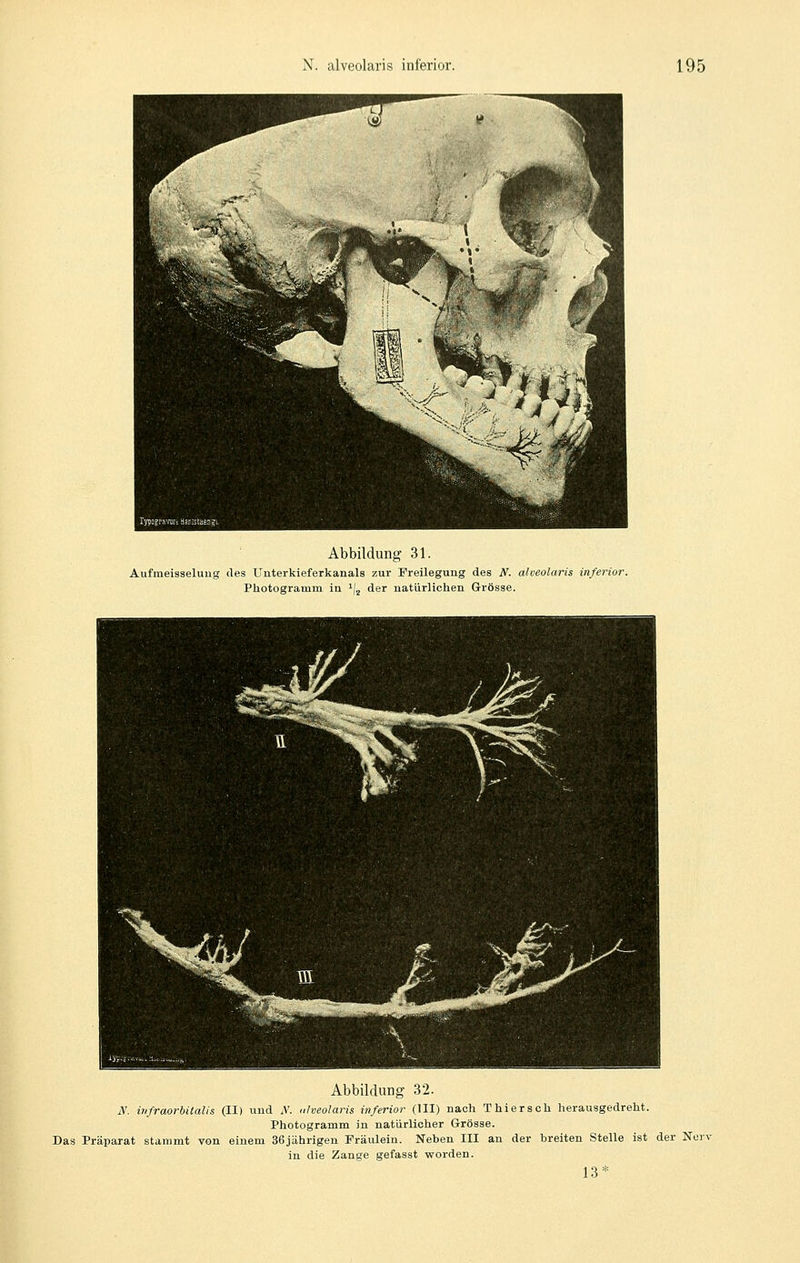 Abbildung 31. Aufmeiaseluug des Unterkieferkanals zur Freilegung des N. alveolaris inferior. Photogramm in ^jj der natürlichen Grösse. Abbildung 32. N. irifraorbitalis (II) und ,\'. alveolaris inferior (III) nach Thiersch herausgedreht. Photogramm in natürlicher Grösse. Das Präparat stammt von einem 36jährigen Fräulein. Neben III an der breiten Stelle ist der Norv in die Zange gefasst worden. 13*