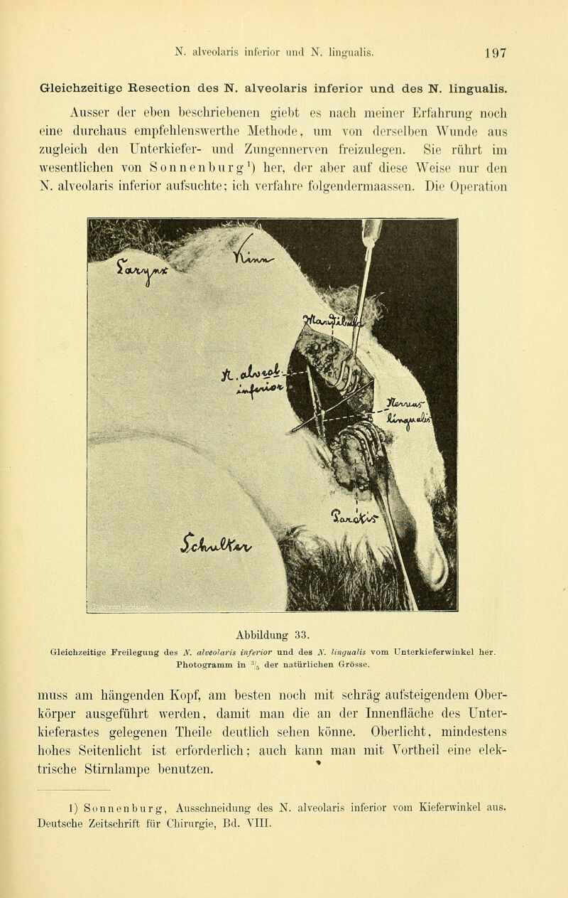 Gleichzeitige Reseotion des N. alveolaris inferior und des N. lingualis. Ausser der eben beschriebenen giebt es nach meiner Erfahrung noch eine durchaus empfehlenswerthe Methode, um von derselben Wunde aus zugleich den Unterkiefer- und Zungennerven freizulegen. Sie rührt im wesentlichen von Sonnenburg^) her, der aber auf diese Weise nur den N. alveolaris inferior aufsuchte; ich verfahre folgendermaassen. Die Operation Abbildung 33. Grleichzeitige Freilegimg des N. alveolaris inferior und des N. lingualis vom Unterkieferwinkel her. Photogramm in '/j der natürlichen Grösse. muss am hängenden Kopf, am besten noch mit schräg aufsteigendem Ober- körper ausgeführt werden, damit man die an der Innenfläche des Unter- kieferastes gelegenen Theile deutlich sehen könne. Oberlicht, mindestens hohes Seitenlicht ist erforderlich; auch kann man mit Yortheil eine elek- trische Stimlampe benutzen. 1) Sonnenburg, Ausschneidung des N. alveolaris inferior vom Kieferwinkel aus. Deutsche Zeitschrift für Chirurgie, Bd. VlII.