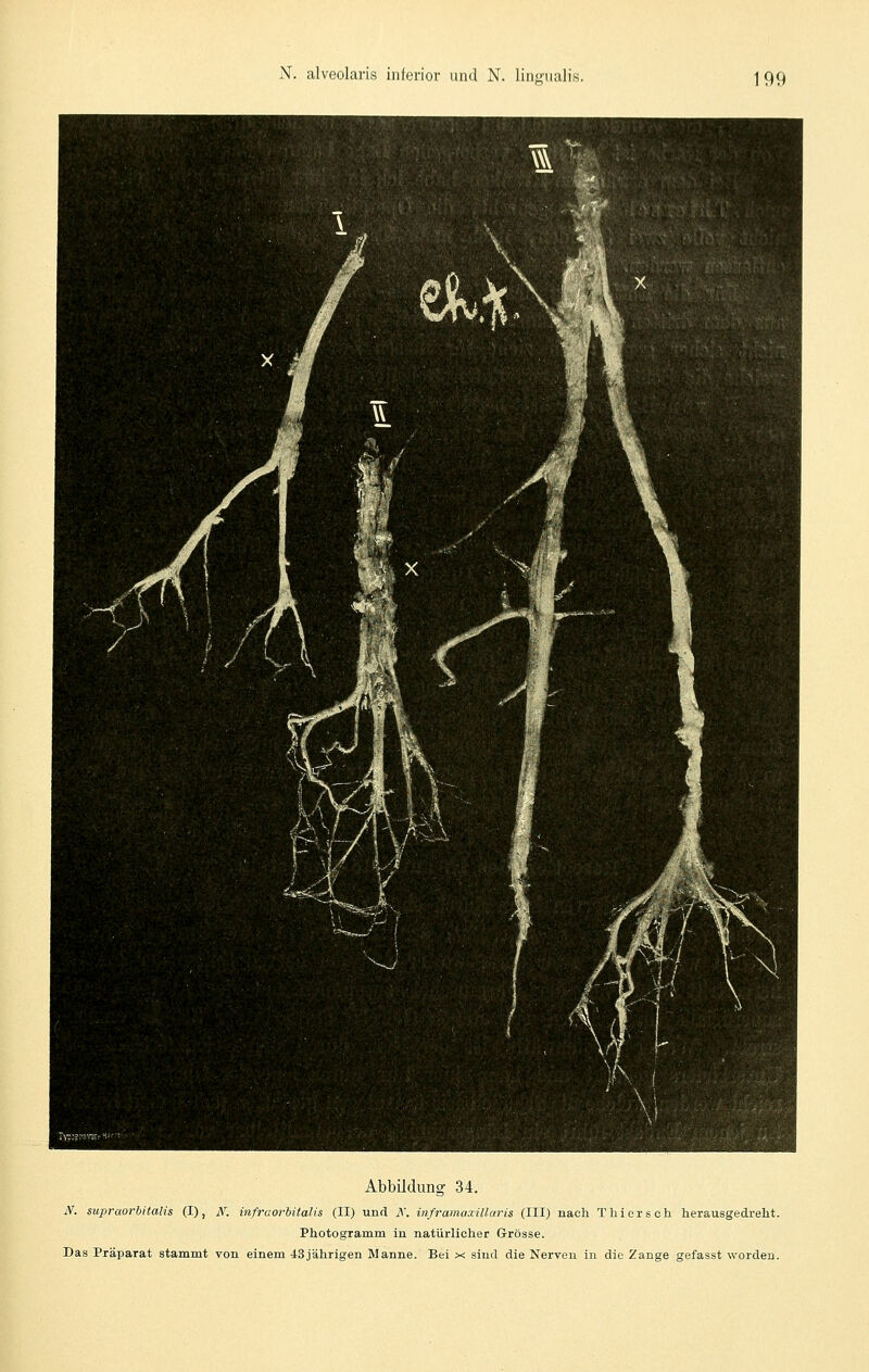 Abbildung 34. N. supraorbitalis (I), A^. infraorbitalü (II) und K. inframa.villaris (III) nach T hier seh herausgedreht. Photogramm in natürlicher Grösse. Das Präparat stammt von einem 43jährigen Manne. Bei x sind die Nerven in die Zange gefasst worden.