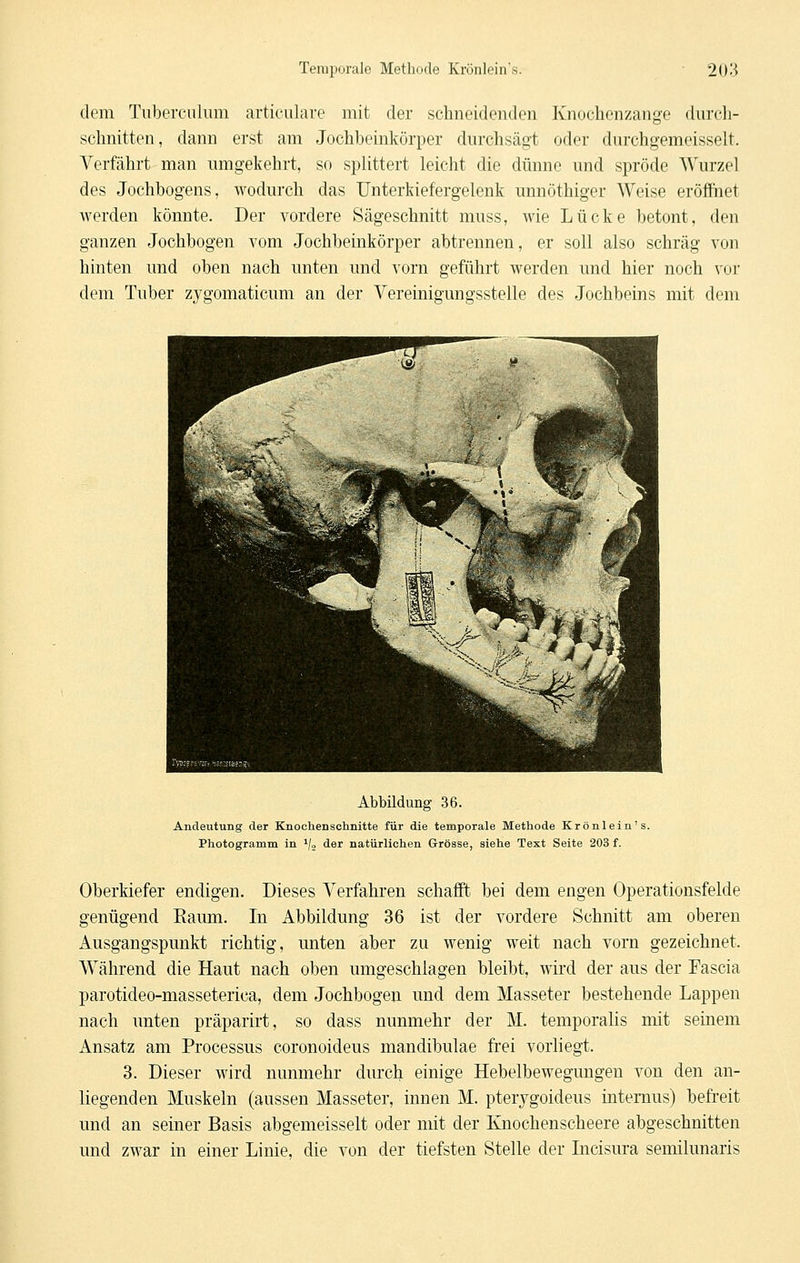dem Tuberciüum articulare mit der schneidenden Knochenzange durch- schnitten, dann erst am Jochheinkörper durchsägt oder durchgemeisselt. Verfährt man umgekehrt, so spHttert leicht die dünne und spröde Wurzel des Jochhogens, wodurch das Unterkiefergelenk unnöthiger Weise eröffnet werden könnte. Der vordere Sägeschnitt muss, wie Lücke betont, den ganzen Jochhogen vom Jochheinkörper abtrennen, er soll also schräg von hinten und oben nach unten und vorn geführt werden und hier noch vor dem Tuber zygomaticum an der Vereinigungsstelle des Jochbeins mit dem Abbildung 36. Andeutung der Knochenschnitte für die temporale Methode Krönlein's. Photogramm in i/„ der natürlichen Grösse, siehe Text Seite 203 f. Oberkiefer endigen. Dieses Verfahren schafft bei dem engen Operationsfelde genügend Eaum. In Abbildung 36 ist der vordere Schnitt am oberen Ausgangspunkt richtig, unten aber zu wenig weit nach vorn gezeichnet. Während die Haut nach oben umgeschlagen bleibt, wird der aus der Fascia parotideo-masseterica, dem Jochbogen und dem Masseter bestehende Lappen nach unten präparirt, so dass nunmehr der M. temporalis mit seinem Ansatz am Processus coronoideus mandibulae frei vorliegt. 3. Dieser wird nunmehr durch einige Hebelbeweguugen von den an- liegenden Muskeln (aussen Masseter, innen M. pterygoideus iutemus) befreit und an seiner Basis ahgemeisselt oder mit der Knochenscheere abgeschnitten und zwar in einer Linie, die von der tiefsten Stelle der Licisura semilunaris