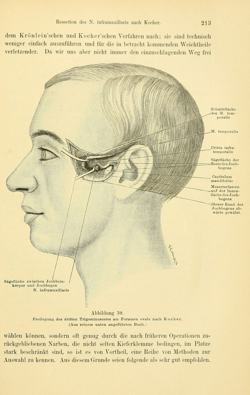 dem Krönlein'schen und Kocher'sclien Verfahren nach; sie sind technisch weniger einfach auszuführen und für die in betracht kommenden Weichtheile verletzender. Da wir uns aber nicht immer den einzuschlagenden Weg frei Schnittfläche des M. tem- poralis M. temporalis Sägefläche der Basis des Joch- bogens ^^wll'WlftB Masseterfasern auf der Innen- fläche des Joch- Oberer Kand des Jochbogens ab- wärts gewälzt. Sägefläche zwischen Jochbein- körper und Jochbogen N. inframaxillaris Abbildung 39. Freilegung des dritten Trigeminusastes am Foramen ovale nach Kocher. (Aus seinem unten angeführten Buch.) wählen können, sondern oft genug durch die nach früheren Operationen zu- rückgebliebenen Narben, die nicht selten Kieferklemme bedingen, im Platze stark beschränkt sind, so ist es von Vortheil, eine Reihe von Methoden zur Auswahl zu kennen. Aus diesem Grunde seien folgende als sehr gut empfohlen.