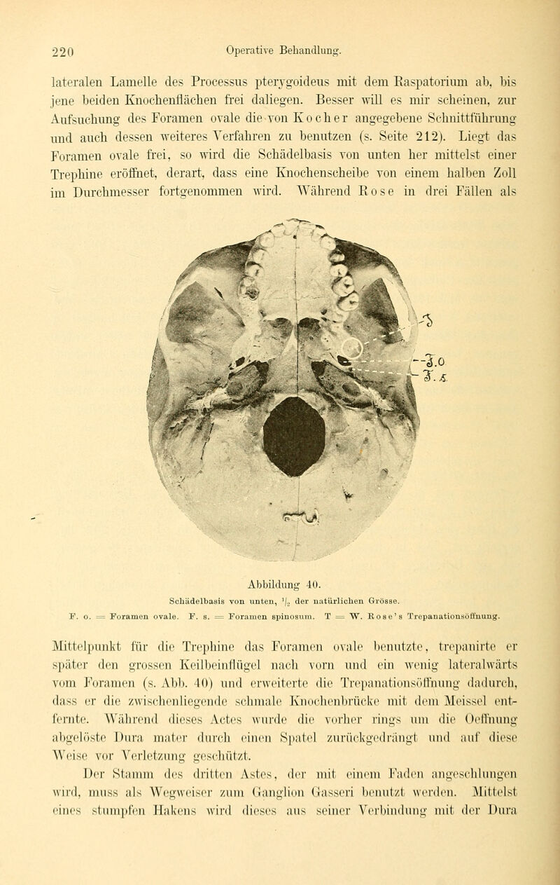 lateralen Lamelle des Processus pterygoideus mit dem Easpatorium ab, bis jene beiden Knocbenflächen frei daliegen. Besser will es mir scheinen, zur Aufsuchung des Foramen ovale die von Kocher angegebene Schnittführung und auch dessen weiteres Verfahren zu benutzen (s. Seite 212). Liegt das Foramen ovale frei, so wird die Schädelbasis von unten her mittelst einer Trephine eröffnet, derart, dass eine Knochenscheibe von einem halben Zoll im Durchmesser fortgenommen wird. Während Rose in drei Fällen als '^ T^^. Abbildung 40. Schädelbasis von unten, 'j., der uatürliclien Grösse. V. o. = Foramen ovale. F. s. = Foramen spinosum. T = W. Rose's Trepauationsöflfnung. Mittelpunkt für die Trephine das Foramen ovale benutzte, trcjianirte er später den grossen Keilbeinflügel nach vorn und ein wenig laterahvärts vom Foramen (s. Abb. 40) und erweiterte die TrepanationsöfFnung dadurch, dass er die zwischenliegende schmale Knochenbrücke mit dem Meissel ent- fernte. Während dieses Actes wurde die vorher rings um die Oeil'nung abgelöste Dura mater durch einen Spatel zurückgedrängt und auf diese Weise vor Verletzung geschützt. Der Stamm des dritten Astes, der mit einem Faden nugescliluugen wird, muss als Wegweiser zum Ganglion Gasseri benut/t werden. Mitlclst eines stumpfen Hakens wird dieses aus seiner V{M'l)indung mit der Dura