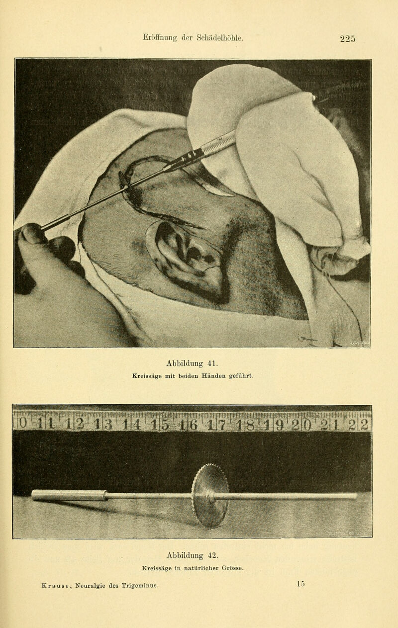 Abbildung 41. Kreissäge mit beiden Händen geführt. l1«SH5;H!y.|.;iiH Abbildung 42. Kreissäge in natürlicher Grösse. Krause, Neuralgie des Trigeminus. 15