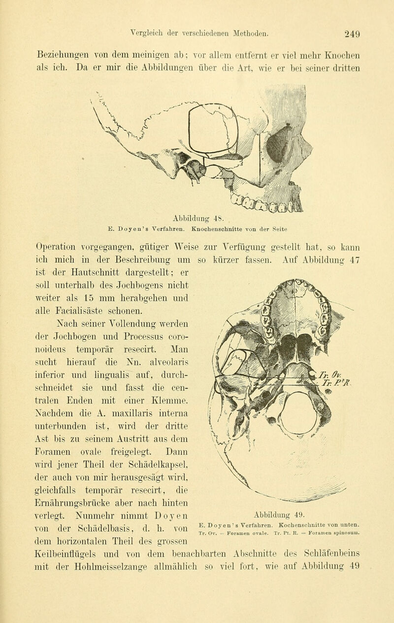 Beziehungen von dem meinigen ab; vor allem entfernt er viel mehr Knochen als ich. Da er mir die Abbildungen über die Art, wie er bei seiner dritten ^ 'i, Abbildung 48. E. Doyeu's Verfahren. Knochenschnitte von der Seite Operation vorgegangen, gütiger Weise zur Verfügung gestellt hat, so kann ich mich in der Beschreibung um so kürzer fassen. Auf Abbildung 47 ist der Hautschnitt dargestellt; er soll unterhalb des Jochbogens nicht weiter als 15 mm herabgehen und alle Facialisäste schonen. Nach seiner Vollendung werden der Jochbogen und Processus coro- noideus temporär resecirt. Man sucht hierauf die Nn. alveolaris inferior und lingualis^ auf, durch- schneidet sie und fasst die cen- tralen Enden mit einer Klemme. Nachdem die A. maxillaris interna unterbunden ist, wird der dritte Ast bis zu seinem Austritt aus dem Foramen ovale freigelegt. Dann wird jener Theil der Schädelkapsel, der auch von mir herausgesägt wird, gleichfalls temporär resecirt, die Ernährungsbrücke aber nach hinten verlegt. Nunmehr nimmt Doyen von der Schädelbasis, d. h. von dem horizontalen Theil des grossen Keilbeinflügels und von dem benachbarten Abschnitte des Schläfenbeins mit der Hohlmeisselzange allmählich so viel fort, wie auf Abbildung 49 Abbildung 49. E. D oy en ' s Verfahren. Kochensohnitte von unten. Tr. Ov. = Foramen ovale. Tr. Pt. K. = Foramen spinosum.