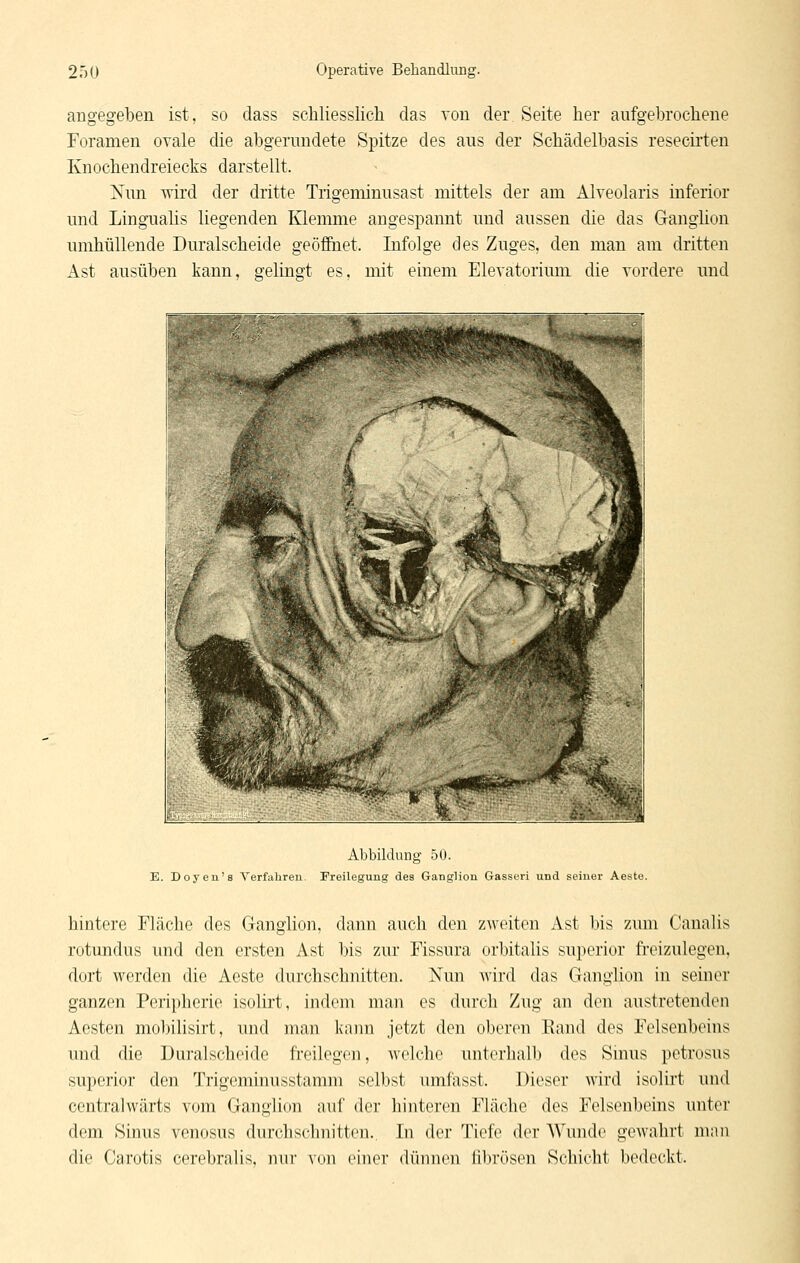 angegeben ist, so dass schliesslich das von der Seite her aufgebrochene Foramen ovale die abgerundete Spitze des aus der Schädelbasis resecirten Knochendreiecks darstellt. ]Sun wird der dritte Trigeminusast mittels der am Alveolaris inferior und Lingualis liegenden Klemme augespannt und aussen die das Ganglion umhüllende Duralscheide geöffnet. Infolge des Zuges, den man am dritten Ast ausüben kann, gelingt es, mit einem Elevatorium die vordere und Abbildung 50. E. Doyen'8 Verfahreu. Freilegung des Ganglion Gasseri und seiner Aeste. hintere Fläche des Ganglion, dann auch den zweiten Ast bis zum Canalis rotundus und den ersten Ast bis zur Fissura orbitalis superior fi-eizulegen, dort werden die Aeste durchschnitten. Nun wird das Ganglion in seiner ganzen Peripherie isolirt, indem man es durch Zug an den austretenden Aesten mol)ilisirt, und man knim jetzt den oberen Rand des Felsenbeins und die Duralscheide freilegen, welche unterhalb des Smus petrosus superior den Trigeminusstamm selbst umfasst. Dieser wird isolirt und centralwärts vom Ganglion auf der hinteren Fläche des Felsenbeins unter dem Sinus venosus durchschnitten., In der Tiefe der Wunde gewahrt mau die Carotis cerebralis, nur von einer dünnen fibrösen Schicht bedeckt.