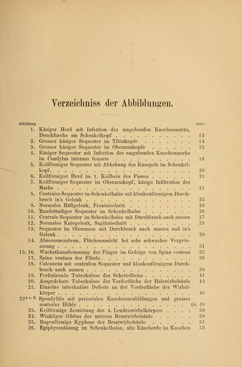 Verzeichniss der Abbildungen. Abbildung Seito 1. Käsiger Herd mit Infection des umgebenden Knochenmarks, Druckfurclie am Schenkelkopf 13 2. Grosser käsiger Sequester im Tibiakopfe 14 3. Grosser käsiger Sequester im Oberarmkopfe 15 4. Käsiger Sequester mit Infection des umgebenden Knochenmarks im Condylus internus femoris 16 5. Keilförmiger Sequester mit Abhebung des Knorpels im Schenkel- kopf 20 6. Keilförmiger Herd im 1. Keilbein des Fusses 21 7. Keilförmiger Sequester im Oberarmkopf, käsige Infiltration des Marks 21 8. Centraler Sequester im Schenkelhalse mit kloakenförmigem Durch- bruch in's Gelenk 25 9. Normales Hüftgelenk, Frontalschnitt 26 10. Randständiger Sequester im Schenkelhalse 26 11. Centrale Sequester im Schenkelhalse mit Durchbruch nach aussen 27 12. Normales Kniegelenk, Sagittalschnitt 28 13. Sequester im Olecranon mit Durchbruch nach aussen und in's Gelenk 29 14. Abscessmembran, Flächenansicht bei sehr schwacher Vergrös- serung 31 15. 16. Wachsthumshemmung der Finger im Gefolge von Spina ventosa 35 17. Spina ventosa der Fibula 36 18. Calcaneus mit centralem Sequester und kloakenförmigem Durch- bruch nach aussen 38 19. Perforirende Tuberkulose des Scheitelbeins ....... 41 20. Ausgedehnte Tuberkulose der Vorderfläche der Hals Wirbelsäule 44 21. Einzelne tuberkulöse Defecte an der Vorderfläche der Wirbel- körper 46 22^^-^-Spondylitis mit periostalen Knochenneubildungen und grosser centraler Höhle 48. 49 23. Keilförmige Zerstörung des 4. Lendenwirbelkörpers .... 50 24. Winkliger Gibbus der unteren Brustwirbelsäule 50 25. Bogenförmige Kyphose der Brustwirbelsäule 51 26. Epiphysenlösung im Schenkelhalse, alte Käseherde im Knochen 53