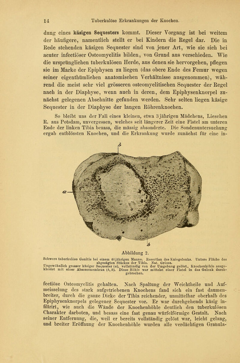 dung eines käsigen Sequesters kommt. Dieser Vorgang ist bei weitem der häufigere, namentlich stellt er bei Kindern die Eegel dar. Die in Eede stehenden käsigen Sequester sind von jener Art, wie sie sich bei acuter infectiöser Osteomyelitis bilden, von Grund aus verschieden. Wie die ursprünglichen tuberkulösen Herde, aus denen sie hervorgehen, pflegen sie im Marke der Epiphysen zu liegen (das obere Ende des Femur wegen seiner eigenthtimlichen anatomischen Verhältnisse ausgenommen), wäh- rend die meist sehr viel grösseren osteomyelitischen Sequester der Eegel nach in der Diaphyse, wenn auch in deren, dem Epiphysenknorpel zu- nächst gelegenen Abschnitte gefunden werden. Sehr selten liegen käsige Sequester in der Diaphyse der langen Eöhrenknochen. So bleibt uns der Fall eines kleinen, etwa 3jährigen Mädchens, Lieschen R. aus Potsdam, unvergessen, welches seit längerer Zeit eine Fistel am unteren Ende der linken Tibia besass, die massig absonderte. Die Sondenuutersuchung ergab entblössten Knochen, und die Erkrankung wurde zunächst für eine in- Abbildung 2. Schwere tuterkulöse Gonitis tei einem 44 jährigen Manne. Eeseetion des Kniegelenks. Untere Fläche des abgesägten Stückes der Tibia. Nat. Grösse. Ungewöhnlich grosser käsiger Sectuester (a), vollständig von der Umgebung gelöst, Knochenhöhle ausge- kleidet mit einer Abscessmembran (6, b). Diese Höhle war mittelst einer Fistel in das Gelenk durch- gebrochen, fectiöse Osteomyelitis gehalten. Nach Spaltung der Weichtheile und Auf- meisselung des stark aufgetriebenen Knochens fand sich ein fast daumen- breiter, durch die ganze Dicke der Tibia reichender, unmittelbar oberhalb des Epiphysenknorpels gelegener Sequester vor. Er war durchgehends käsig in- filtrirt, wie auch die Wände der Knochenhöhle deutlich den tuberkulösen Charakter darboten, und besass eine fast genau würfelförmige Gestalt. Nach seiner Entfernung, die, weil er bereits vollständig gelöst war, leicht gelang, und breiter Eröffnung der Knochenhöhle wurden alle verdächtigen Granula-