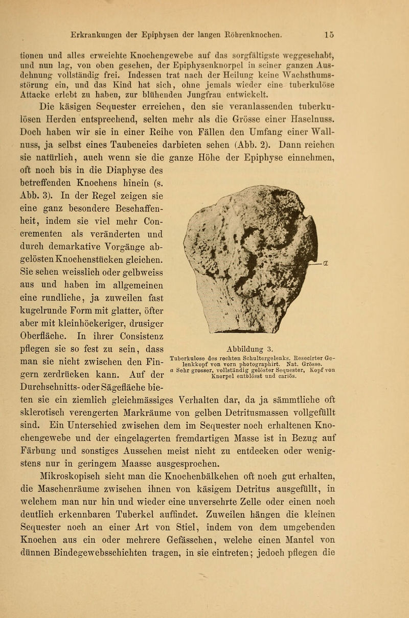 tionen und alles erweichte Knochengewebe auf das sorgfältigste weggescliabt, und nun lag, von oben gesehen, der Epiphyseuknorpcl in seiner ganzen Aus- dehnung vollständig frei. Indessen trat nach der Heilung keine Wachsthums- störung ein, und das Kind hat sich, ohne jemals wieder eine tuberkulöse Attacke erlebt zu haben, zur blühenden Jungfrau entwickelt. Die käsigen Sequester erreichen, den sie veranlassenden tuberku- lösen Herden entsprechend, selten mehr als die Grösse einer Haselnuss. Doch haben wir sie in einer Keihe von Fällen den Umfang einer Wall- nuss, ja selbst eines Taubeneies darbieten sehen (Abb. 2). Dann reichen sie natürlich, auch vrenn sie die ganze Höhe der Epiphyse einnehmen, oft noch bis in die Diaphyse des betreffenden Knochens hinein (s. .^ Abb. 3). In der Eegel zeigen sie eine ganz besondere Beschaffen- heit, indem, sie viel mehr Con- crementen als veränderten und durch demarkative Vorgänge ab- gelösten Knochenstticken gleichen. Sie sehen weisslich oder gelbweiss aus und haben im allgemeinen eine rundliche, ja zuv^reilen fast kugelrunde Form mit glatter, öfter aber mit kleinhöckeriger, drusiger Oberfläche. In ihrer Consistenz pflegen sie so fest zu sein, dass man sie nicht zwischen den Fin- gern zerdrücken kann. Auf der Durchschnitts- oder Sägefläche bie- ten sie ein ziemlich gleichmässiges Verhalten dar, da ja sämmtliche oft sklerotisch verengerten Markräume von gelben Detritusmassen vollgefüllt sind. Ein Unterschied zwischen dem im Sequester noch erhaltenen Kno- chengewebe und der eingelagerten fremdartigen Masse ist in Bezug auf Färbung und sonstiges Aussehen meist nicht zu entdecken oder wenig- stens nur in geringem Maasse ausgesprochen. Mikroskopisch sieht man die Knochenbälkchen oft noch gut erhalten, die Maschenräume zwischen ihnen von käsigem Detritus ausgefüllt, in welchem man nur hin und wieder eine unversehrte Zelle oder einen noch deutlich erkennbaren Tuberkel auffindet. Zuweilen hängen die kleinen Sequester noch an einer Art von Stiel, indem von dem umgebenden Knochen aus ein oder mehrere Gefässchen, welche einen Mantel von dünnen Bindegewebsschichten tragen, in sie eintreten; jedoch pflegen die Abbildung 3. Tuberkulose des rechten Sehultergelenks. Eesecirter Ge- lenkkopf von vorn photographirt. Nat. Grösse, o Sehr grosser, vollständig gelöster Secinester, Kopf von Knorpel entblösst und cariös.