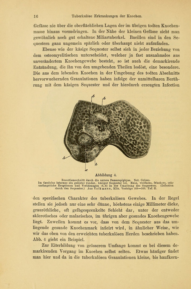 Gefässe nie über die oberfläehlichen Lagen der im übrigen todten Knochen- masse hinaus vorzudringen. In der Nähe der kleinen Gefässe sieht man gewöhnlich noch gut erhaltene Miliartuberkel. Bacillen sind in den Se- questern ganz ungemein spärlich oder überhaupt nicht aufzufinden. Ebenso wie der käsige Sequester selbst sich in jeder Beziehung von dem osteomyelitischen unterscheidet, welcher ja fast ausnahmslos aus unverändertem Knochengewebe besteht, so ist auch die demarkirende Entzündung, die ihn von den umgebenden Theilen loslöst, eine besondere. Die aus dem lebenden Knochen in der Umgebung des todten Abschnitts hervorwuchernden Granulationen haben infolge der unmittelbaren Berüh- rung mit dem käsigen Sequester und der hierdurch erzeugten Infection 6^ Abbildung 4. Keseetionsselinitt durch die untere Femnrepiphyse. Nat. Grösse. Im Oondylus internus ein gelöster runder, käsiger Seciuester (a). Neue, vielfache, frischere, sehr umfangreiche Eruptionen und Verkäsnngen (6,6) in der Umgebung des Sequesters. (Infection durch den Sequester.) Aus Volk mann, Klin. Vorträge 168—1Ö9. Taf. II. den specifischen Charakter des tuberkulösen Gewebes. In der Eegel stellen sie jedoch nur eine sehr dünne, höchstens einige Millimeter dicke, grauröthliche, oft gelbgesprenkelte Schicht dar, unter der entweder sklerotisches oder malacisches, im übrigen aber gesundes Knochengewebe liegt. Zuweilen kommt es vor, dass von dem Sequester aus das um- liegende gesunde Knochenmark inficirt wird, in ähnlicher Weise, wie wir das oben von den erweichten tuberkulösen Herden beschrieben haben. Abb. 4 giebt ein Beispiel. Zur Eiterbildung von grösserem Umfange kommt es bei diesem de- markirenden Vorgang im Knochen selbst selten. Etwas häufiger findet man hier und da in die tuberkulösen Granulationen kleine, bis hanfkorn-