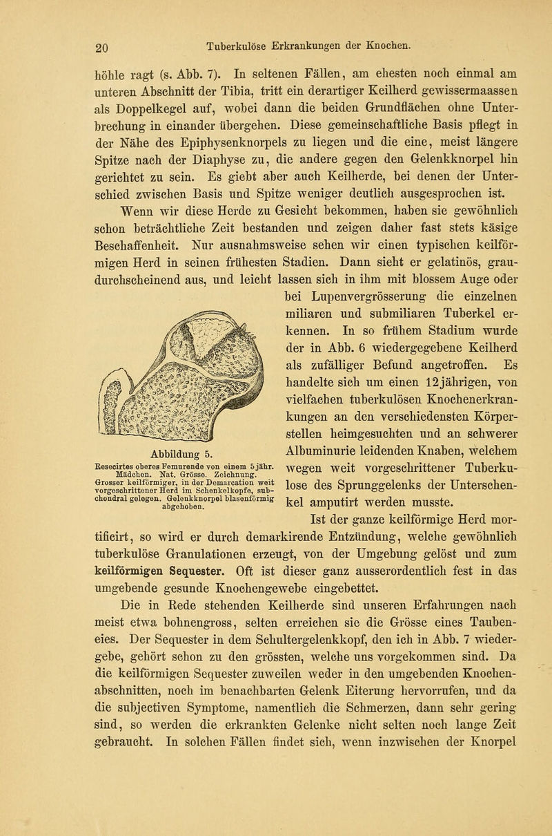 höhle ragt (s. Abb. 7). In seltenen Fällen, am ehesten noch einmal am unteren Abschnitt der Tibia, tritt ein derartiger Keilherd gewissermaassen als Doppelkegel auf, wobei dann die beiden Grundflächen ohne Unter- brechung in einander übergehen. Diese gemeinschaftliche Basis pflegt in der Nähe des Epiphysenknorpels zu liegen und die eine, meist längere Spitze nach der Diaphyse zu, die andere gegen den Gelenkknorpel hin gerichtet zu sein. Es giebt aber auch Keilherde, bei denen der Unter- schied zwischen Basis und Spitze weniger deutlich ausgesprochen ist. Wenn wir diese Herde zu Gesicht bekommen, haben sie gewöhnlich schon beträchtliche Zeit bestanden und zeigen daher fast stets käsige Beschaffenheit. Nur ausnahmsweise sehen wir einen typischen keilför- migen Herd in seinen frühesten Stadien. Dann sieht er gelatinös, grau- durchscheinend aus, und leicht lassen sich in ihm mit blossem Auge oder bei Lupenvergrösserung die einzelnen miliaren und submiliaren Tuberkel er- kennen. In so frühem Stadium wurde der in Abb. 6 wiedergegebene Keilherd als zufälliger Befund angetroffen. Es handelte sich um einen 12jährigen, von vielfachen tuberkulösen Knochenerkran- kungen an den verschiedensten Körper- stellen heimgesuchten und an schwerer Albuminurie leidenden Knaben, welchem wegen weit vorgeschrittener Tuberku- lose des Sprunggelenks der Unterschen- kel amputirt werden musste. Ist der ganze keilförmige Herd mor- tificirt, so wird er durch demarkirende Entzündung, welche gewöhnlich tuberkulöse Granulationen erzeugt, von der Umgebung gelöst und zum keilförmigen Sequester. Oft ist dieser ganz ausserordentlich fest in das umgebende gesunde Knochengewebe eingebettet. Die in Eede stehenden Keilherde sind unseren Erfahrungen nach meist etwa bohnengross, selten erreichen sie die Grösse eines Tauben- eies. Der Sequester in dem Schultergelenkkopf, den ich in Abb. 7 wieder- gebe, gehört schon zu den grössten, welche uns vorgekommen sind. Da die keilförmigen Sequester zuweilen weder in den umgebenden Knochen- abschnitten, noch im benachbarten Gelenk Eiterung hervorrufen, und da die subjectiven Symptome, namentlich die Schmerzen, dann sehr gering sind, so werden die erkrankten Gelenke nicht selten noch lange Zeit gebraucht. In solchen Fällen findet sieh, wenn inzwischen der Knorpel Abbildung 5. Kesecirtes oljeres Femnrende von einem 5 jähr. Mädehen. Nat. Grösse. Zeichnung. Grosser keilförmiger, in der Demarcation weit vorgeschrittener Herd im Schenkelkopfe, suh- chondral gelegen. Gelenkknorpel blasenförmig abgehoben.