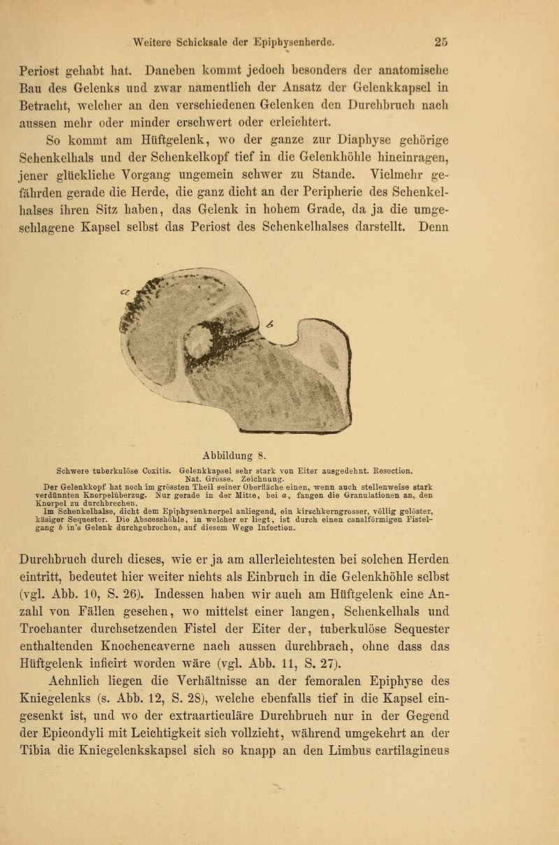Periost gehabt hat. Daneben kommt jedoch besonders der anatomisclic Bau des Gelenks und zwar namentlich der Ansatz der Gelenkkapsel in Betracht, welcher an den verschiedenen Gelenken den Durchbruch nach aussen mehr oder minder erschwert oder erleichtert. So kommt am Hüftgelenk, wo der ganze zur Diaphyse gehörige Schenkelhals und der Schenkelkopf tief in die Gelenkhöhle hineinragen, jener glückliche Vorgang ungemein schwer zu Stande. Vielmehr ge- fährden gerade die Herde, die ganz dicht an der Peripherie des Schenkel- halses ihren Sitz haben, das Gelenk in hohem Grade, da ja die umge- schlagene Kapsel selbst das Periost des Schenkelhalses darstellt. Denn Abbildung 8. Schwere tuberkulöse Coxitis. Gelenkkapsel sehr stark von Eiter ausgedehnt. Keseetion. Nat. Grösse. Zeichnung. Der Gelenkkopf hat noch im grössten Theil seiner Oberfläche einen, -wenn auch stellenweise stark verdünnten Knorpelüberzug. Nur gerade in der Mitte, bei a, fangen die Granulationen an, den Knorpel zu durchbrechen. Im Schenkelhalse, dicht dem Epiphysenknorpel anliegend, ein kirschkerngrosser, völlig gelöster, käsiger Sequester. Die Absoesshöhle, in welcher er liegt, ist durch einen canalförmigen Fistel- gang & in's Gelenk durchgebrochen, auf diesem Wege Infection. Durchbruch durch dieses, wie er ja am allerleichtesten bei solchen Herden eintritt, bedeutet hier weiter nichts als Einbruch in die Gelenkhöhle selbst (vgl. Abb. 10, S. 26). Indessen haben wir auch am Hüftgelenk eine An- zahl von Fällen gesehen, wo mittelst einer langen, Schenkelhals und Trochanter durchsetzenden Fistel der Eiter der, tuberkulöse Sequester enthaltenden Knochencaverne nach aussen durchbrach, ohne dass das Hüftgelenk inficirt worden wäre (vgl. Abb. 11, S. 27). Aehnlich liegen die Verhältnisse an der femoralen Epiphyse des Kniegelenks (s. Abb. 12, S. 28), welche ebenfalls tief in die Kapsel ein- gesenkt ist, und wo der extraarticuläre Durchbruch nur in der Gegend der Epicondyli mit Leichtigkeit sich vollzieht, während umgekehrt an der Tibia die Kniegelenkskapsel sich so knapp an den Limbus cartilagineus