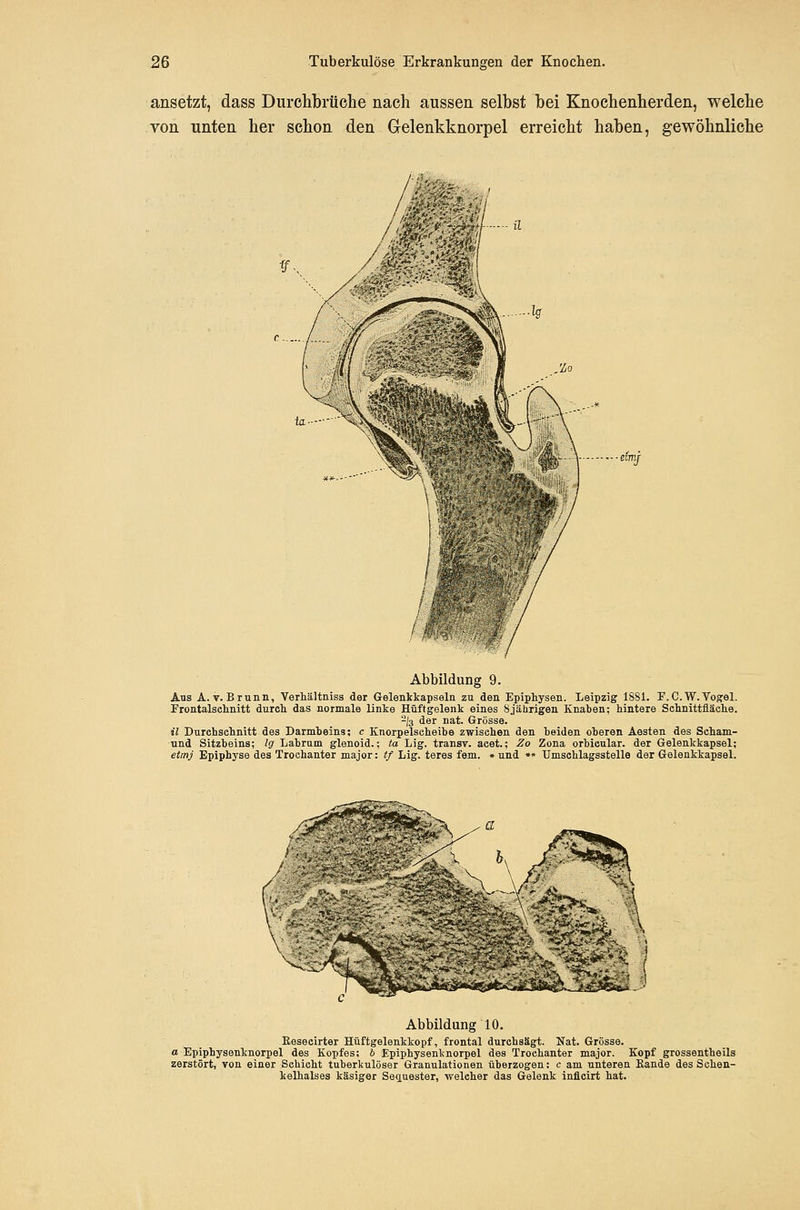 ansetzt, dass Durchbrüclie nach aussen selbst bei Knochenherden, welche von unten her schon den Gelenkknorpel erreicht haben, gewöhnliche Abbildung 9. Ans A.V.Brunn, Verliältniss der Gelenkkapseln zu den Epiphysen. Leipzig 1881. F.C.W.Vogel. Prontalsclinitt durch das normale linke Hüftgelenk eines 8jährigen Knaben; hintere Schnittfläche. 2/3 der nat. Grösse. il Durchschnitt des Darmbeins; c Enorpelscheibe zwischen den beiden oberen Aesten des Scham- nnd Sitzheins; lg Labrum glenoid.; ta Lig. transv. acet.; 2o Zona orbicular. der Gelenkkapsel; etmj Epiphyse des Trochanter major: tf Lig. teres fem. ♦ und »* TJmschlagsstelle der Gelenkkapsel. ... .:%S- ^\ Abbildung 10. Kesecirter Hüftgelenkkopf, frontal durchsägt. Nat. Grösse. a Epiphysenknorpel des Kopfes; 6 Epiphysenknorpel des Trochanter major. Kopf grossentheils zerstört, von einer Schicht tuberkulöser Granulationen überzogen; c am unteren Kande des Schen- kelhalses käsiger Sec|.uester, welcher das Gelenk inflcirt hat.