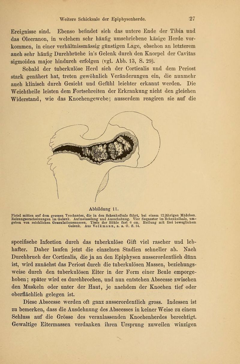 Ereignisse sind. Ebenso befindet sich das untere Ende der Tibia und das Olecranon, in welchem sehr häufig umschriebene käsige Herde vor- kommen, in einer verhältnissmässig günstigen Lage, obschon an letzterem auch sehr häufig Durchbrüche in's Gelenk durch den Knorpel der Cavitas sigmoidea major hindurch erfolgen (vgl. Abb. 13, S. 29). Sobald der tuberkulöse Herd sich der Corticalis und dem Periost stark genähert hat, treten gewöhnlich Veränderungen ein, die nunmehr auch klinisch durch Gesicht und Gefühl leichter erkannt werden. Die Weichtheile leisten dem Fortschreiten der Erkrankung nicht den gleichen Widerstand, wie das Knochengewebe; ausserdem reagiren sie auf die w_ 1 J / m Abbildung 11. Fistel mitten auf dem grossen Trochanter, die in den Schenkelhals führt, hei einem I2jährigen Mädchen. Keizungserscheinnngen im Gelenk. Aufmeisselung und Aussehahnng. Vier Sequester im Schenkelhals, um- gehen von reichlichen Granulationsmassen. Tiefe der Höhle fast 6 cm. Heilung mit frei beweglichem Gelenk. Aus Volkmann, a. a. 0. S. 14. specifische Infection durch das tuberkulöse Gift viel rascher und leb- hafter. Daher laufen jetzt die einzelnen Stadien schneller ab. Nach Durchbruch der Corticalis, die ja an den Epiphysen ausserordentlich dünn ist, wird zunächst das Periost durch die tuberkulösen Massen, beziehungs- weise durch den tuberkulösen Eiter in der Form einer Beule emporge- hoben ; später wird es durchbrochen, und nun entstehen Abscesse zwischen den Muskeln oder unter der Haut, je nachdem der Knochen tief oder oberflächlich gelegen ist. Diese Abscesse werden oft ganz ausserordentlich gross. Indessen ist zu bemerken, dass die Ausdehnung des Abscesses in keiner Weise zu einem Schluss auf die Grösse des veranlassenden Knochenherdes berechtigt. Gewaltige Eitermassen verdanken ihren Ursprung zuweilen winzigen