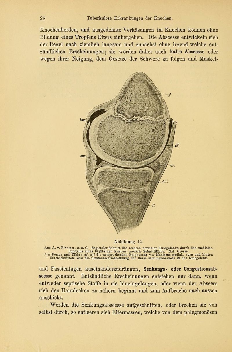 Knoehenlierden, und ausgedehnte Verkäsungen im Knochen können ohne Bildung eines Tropfens Eiters einhergehen. Die Ahseesse entwickeln sich der Eegel nach ziemlich langsam und zunächst ohne irgend welche ent- zündlichen Erscheinungen; sie werden daher auch kalte Abscesse oder wegen ihrer Neigung, dem Gesetze der Schwere zu folgen und Muskel- A Abbildung 12. Aus A. T. B mnn, a. a. 0. Sagitfalei Schnitt des rechten normalen Kniegelenis durch den medialen Condylus eines lö jährigen Knahen; mediale Schnittfläche. Nat. Grösse. f,ii Pemur und Tihia; eif. esti die entsprechenden Epiphysen; mm Meniscus medial., vorn und hinten durchschnitten; bsm die Communicationsöffnung der Bursa semimemhranosa in das Kniegelenk. und Fascienlagen auseinanderzudrängen, Senkungs- oder Congestionsah- scesse genannt. Entzündliche Erscheinungen entstehen nur dann, wenn entweder septische Stoffe in sie hineingelangen, oder wenn der Ahscess sich den Hautdecken zu nähern beginnt und zum Aufbruche nach aussen anschickt. Werden die Senkungsabscesse aufgeschnitten, oder brechen sie von selbst durch, so entleeren sich Eitermassen, welche von dem phlegmonösen