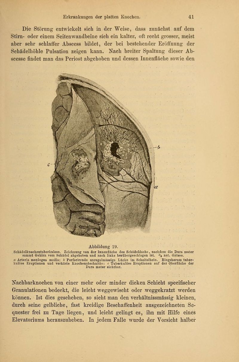 Die Störung entwickelt sich in der Weise, dass zunächst auf dem Stirn- oder einem Seitenwandbeine sich ein kalter, oft recht gi-osser, meist aber sehr schlaifer Abscess bildet, der bei bestehender Eröffnung der Schädelhöhle Pulsation zeigen kann. Nach breiter Spaltung dieser Ab- scesse findet man das Periost abgehoben und dessen Innenfläche sowie den -^b Abbildung 19. Scliädelkiiochentul)eT]!:ulose. Zeiehnung von der Innenfläehe des Schädeldachs, nachdem die Dura mater sammt Gehirn vom Schädel abgehoben und nach links herübergeschlagen ist. ^j^ nat. Grösse. a Arteria meningea media; h Perforirende unregelmässige Lücke im Scheitelbein. Ringsherum tuber- kulöse Eruptionen und verkäste Knochenabschnitte: c Tuberkulöse Eruptionen auf der Oberfläche der Dura mater sichtbar. Nachbarknochen von einer mehr oder minder dicken Schicht speeifischer Granulationen bedeckt, die leicht weggewischt oder weggekratzt werden können. Ist dies geschehen, so sieht man den verhältnissmässig kleinen, durch seine gelbliche, fast kreidige Beschaffenheit ausgezeichneten Se- quester frei zu Tage liegen, und leicht gelingt es, ihn mit Hilfe eines Elevatoriums herauszuheben. In jedem Falle wurde der Vorsicht halber