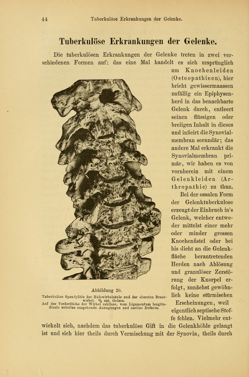 Tuberkulöse Erkrankungen der Gelenke. Die tuberkulösen Erkrankungen der Gelenke treten in zwei ver- schiedenen Formen auf: das eine Mal handelt es sich ursprünglich um Knochenleiden (Osteopathieen), hier bricht gewissermaassen zufällig ein Epiphysen- herd in das benachbarte Gelenk durch, entleert seinen flüssigen oder breiigen Inhalt in dieses und inficirt die Synovial- membran secundär; das andere Mal erkrankt die Synovialmembran pri- mär, wir haben es von vornherein mit einem Gelenkleiden (Ar- thropathie) zu thun. Bei der ossalen Form der Gelenktuberkulose erzeugt der Einbruch in's Gelenk, welcher entwe- der mittelst einer mehr oder minder grossen Knochenfistel oder bei bis dicht an die Gelenk- fläche herantretenden Herden nach Ablösung und granulöser Zerstö- rung der Knorpel er- folgt, zunächst gewöhn- lich keine stürmischen Erscheinungen, weil eigentlich septische Stof- fe fehlen. Vielmehr ent- wickelt sich, nachdem das tuberkulöse Gift in die Gelenkhöhle gelangt ist und sich hier theils durch Vermischung mit der Synovia, theils durch Abbildung 20. Tuberkulöse Spondylitis der HalsTvirtelsäule und der otersten Brust Wirbel. ^Jn nat. Grösse. Auf der Vorderfläclie der Wirbel zahllose, Tom Ligamentum longitu- dinale anterins ausgehende Annagungen und cariöse Defecte.
