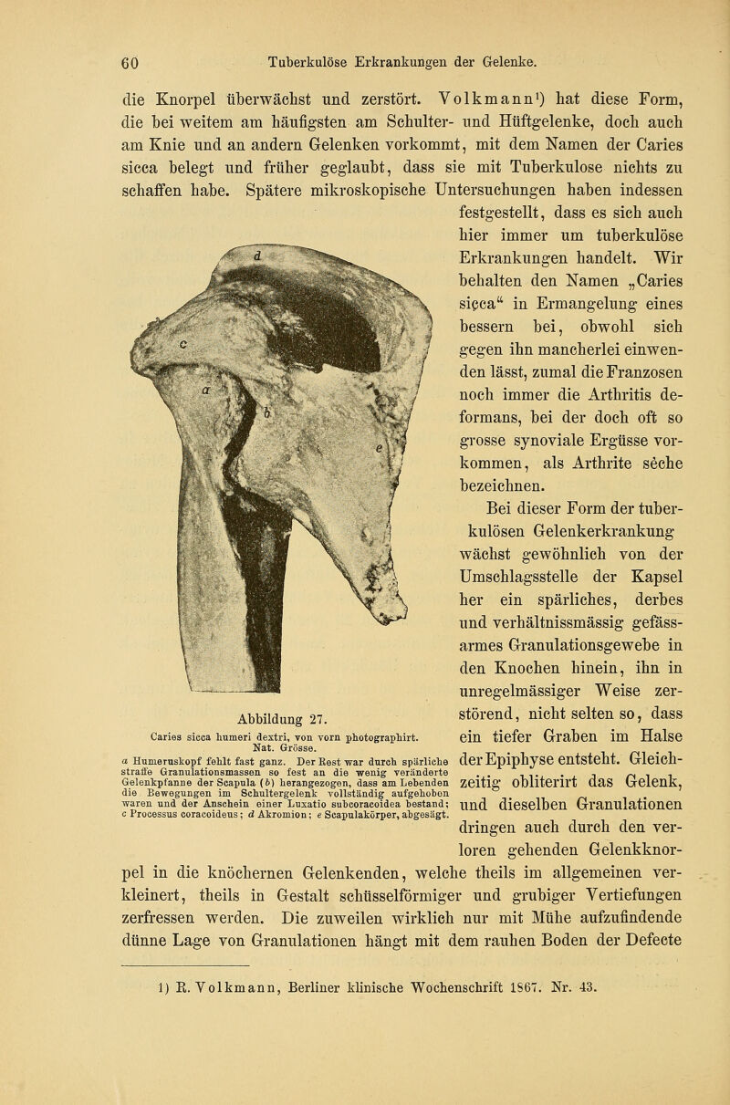die Knorpel überwächst und zerstört. Volkmann^ tat diese Form, die bei weitem am häufigsten am Schulter- und Hüftgelenke, doch auch am Knie und an andern Gelenken vorkommt, mit dem Namen der Caries sicca belegt und früher geglaubt, dass sie mit Tuberkulose nichts zu schaffen habe. Spätere mikroskopische Untersuchungen haben indessen festgestellt, dass es sich auch hier immer um tuberkulöse Erkrankungen handelt. Wir behalten den Namen „Caries sicjca in Ermangelung eines bessern bei, obwohl sich gegen ihn mancherlei einwen- den lässt, zumal die Franzosen noch immer die Arthritis de- formans, bei der doch oft so grosse synoviale Ergüsse vor- kommen, als Arthrite seche bezeichnen. Bei dieser Form der tuber- kulösen Gelenkerkrankung wächst gewöhnlich von der Umschlagsstelle der Kapsel her ein spärliches, derbes und verhältnissmässig gefäss- armes Granulationsgewebe in den Knochen hinein, ihn in unregelmässiger Weise zer- störend , nicht selten so, dass ein tiefer Graben im Halse Abbildung 27. Caries sieea Ixumeri dextri, von vorn pliotograpliirt. Nat. Grösse. _ i z^i • i a Humernstopf fehlt fast ganz. Der Eest war durch spärliche der EpiphjSe entsteht. Glcich- strafie Granulationsmassen so fest an die wenig veränderte . . t,tj. • j. j n ^ i Gelenkpfanne der Seapula (6) herangezogen, dass am Lebenden zeitig Obllteril't daS GelCUk, die Bewegungen im Schultergelenk vollständig aufgehoben _ /^ i • waren und der Ansehein einer Luxatio subcoracoidea bestand; und dieselben GraUUlationCn c Processus coracoideus; dAkromion; e Seapulakörper, abgesägt. dringen auch durch den ver- loren gehenden Gelenkknor- pel in die knöchernen Gelenkenden, welche theils im allgemeinen ver- kleinert, theils in Gestalt schüsseiförmiger und grubiger Vertiefungen zerfressen werden. Die zuweilen wirklieh nur mit Mühe aufzufindende dünne Lage von Granulationen hängt mit dem rauhen Boden der Defecte 1) R. Volkmann, Berliner klinische Wochenschrift 1867. Nr. 43.