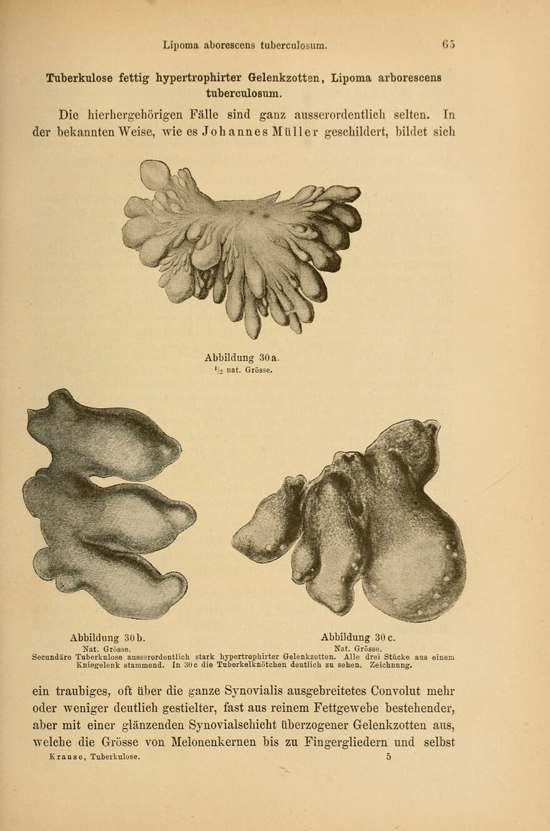Tuberkulose fettig hypertrophirter Gelenkzotten, Lipoma arborescens tuberculosum. Die hierherg-eliörigen Fälle sind ganz ausserordentlich selten. In der bekannten Weise, wie es Johannes Müller geschildert, bildet sich Abbildung 30 a. ^jo nat. Grösse. Abbildung 30 b. Abbildung 30 c. Nat. Grösse. Nat. Grösse. Secundäre Tuberkulose ausserordentlieli stark hypertrophirter Gelenkzotten. Alle drei Stücke aus einem Kniegelenk stammend. In 30 e die Tuberkelknötehen deutlich zu sehen. Zeichnung. ein traubiges, oft über die ganze Synovialis ausgebreitetes Convolut mehr oder weniger deutlich gestielter, fast aus reinem Fettgewebe bestehender, aber mit einer glänzenden Synovialschicht überzogener Gelenkzotten aus, welche die Grösse von Melonenkernen bis zu Fingergliedern und selbst Krause, Tuberkulose. 5