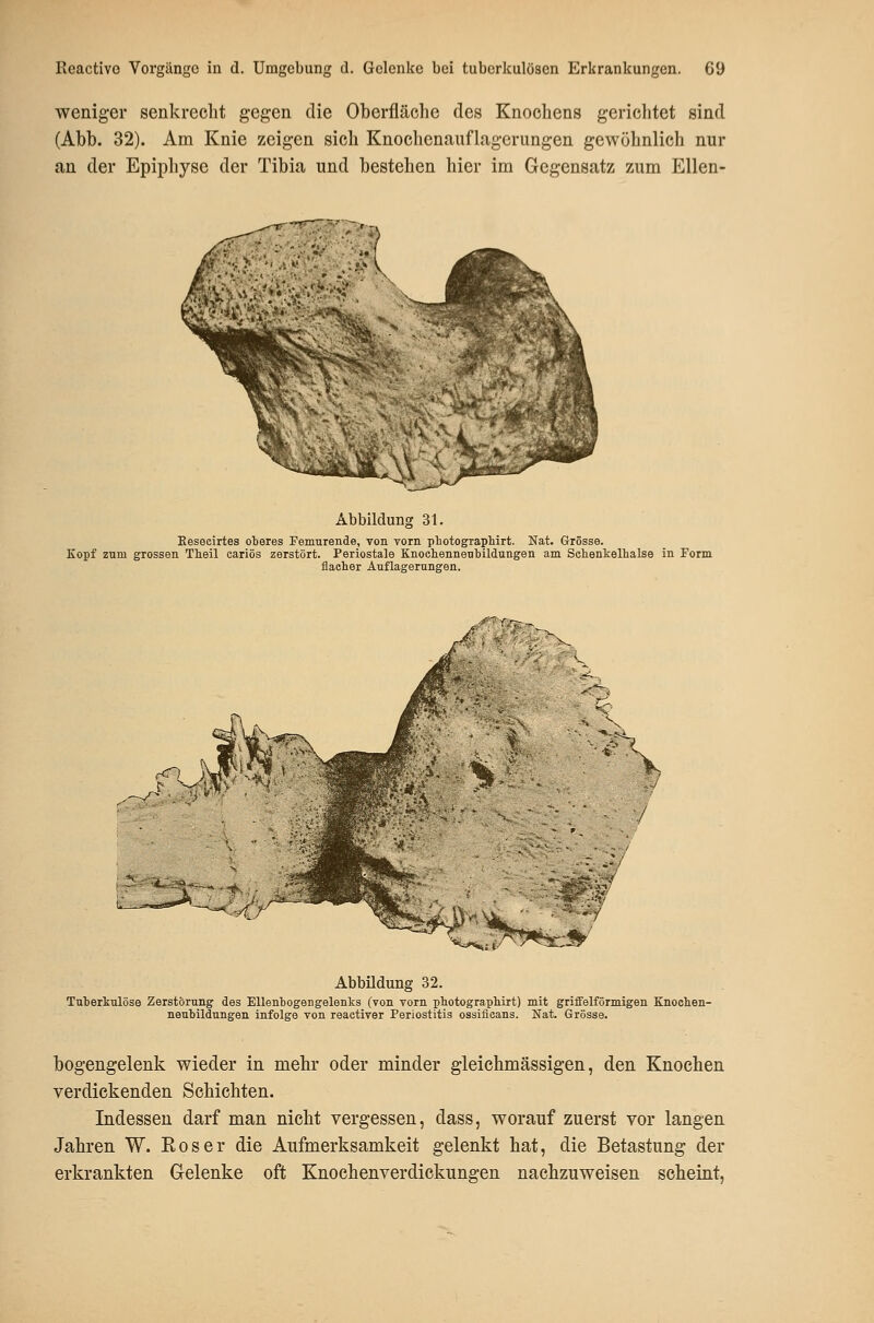 weniger senkrecht gegen die Oberfläche des Knochens gerichtet sind (Abb. 32). Am Knie zeigen sich Knochenauflagerungen gewöhnlich nur an der Epiphyse der Tibia und bestehen hier im Gegensatz zum Ellen- Abbildung 31. Eeseeirtes oberes Fenmrende, von vorn photographirt. Nat. Grösse. Kopf zum grossen Theil cariös zerstört. Periostale Knoehennenbildungen am Sehenkelhalse in Form flacher Auflagerungen. / :^ Abbildung 32. Tuterkulöse Zerstörung des Ellentogengelenks (von vorn photograpliirt) mit griffeiförmigen Knoehen- neubildungen infolge von reactiver Periostitis ossificans. Nat. Grösse. bogengelenk wieder in mehr oder minder gleichmässigen, den Knochen verdickenden Schichten. Indessen darf man nicht vergessen, dass, worauf zuerst vor langen Jahren W. Roser die Aufmerksamkeit gelenkt hat, die Betastung der erkrankten Gelenke oft Knochenverdickungen nachzuweisen scheint,