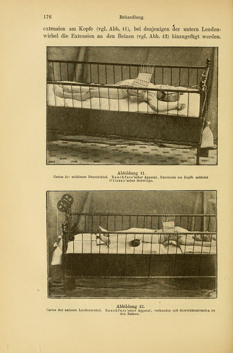 extension am Kopfe (vgl. Abb. 41), bei denjenigen der untern Lenden- wirbel die Extension an den Beinen (vgl. Abb. 42) hinzugefügt werden. Abbildung 41. Caries der mittleren Brustwirbel. Rauehfuss'seher Apparat, Extension am Kopfe mittelst Gr 1 i s s 0 n'scher Schwinge. Abbildung 42. Caries der nnteren LendeEwirbel. ßauchfuss'scher Apparat, verbunden mit Gewicbtsextensicn an den Beinen.