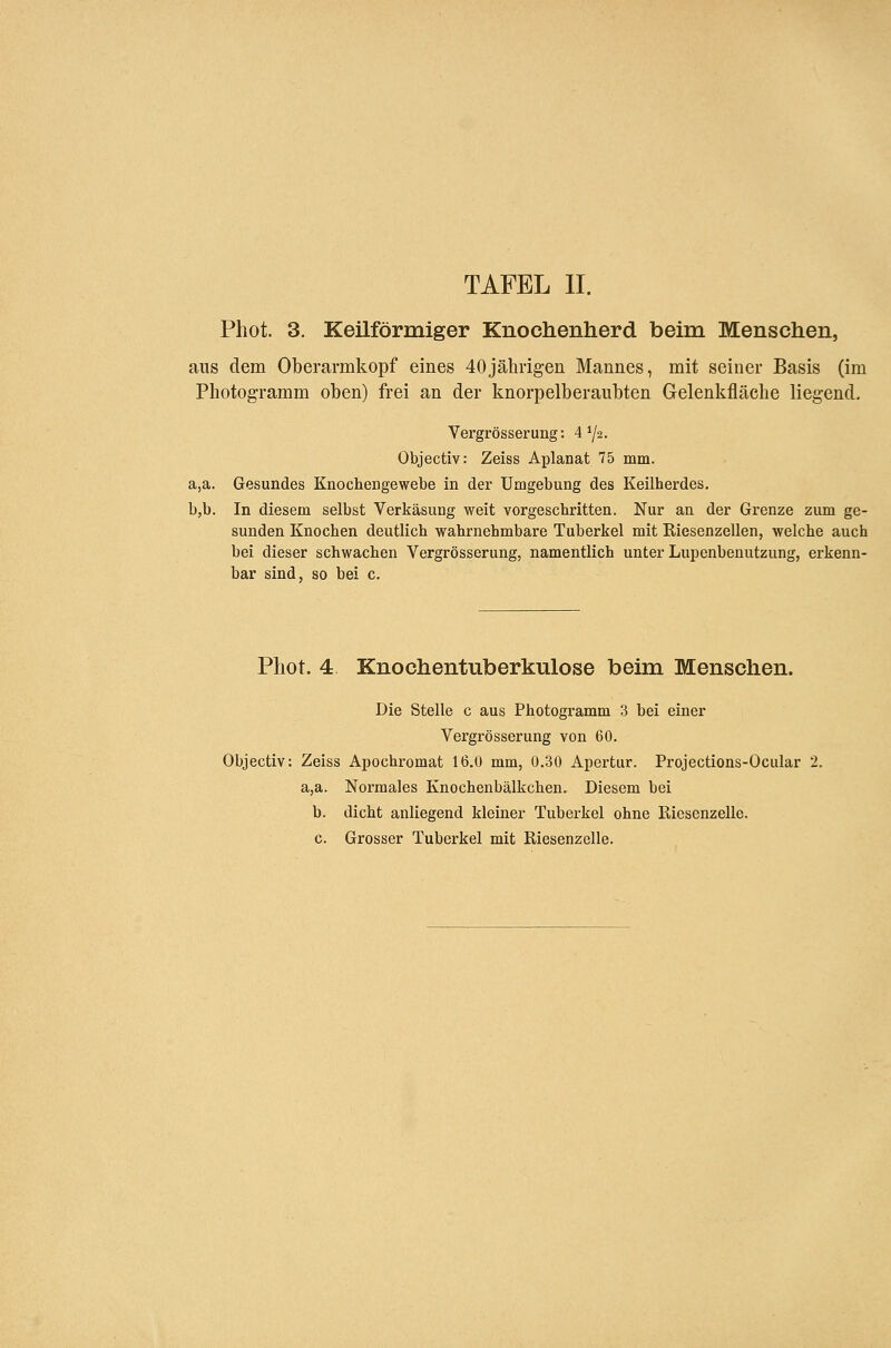 Phot. 3. Keilförmiger Knochenherd beim Menschen, aus dem Oberarmkopf eines 40jähngen Mannes, mit seiner Basis (im Photogramm oben) frei an der knorpelberaubten Gelenkfläche liegend. Vergrösserung: A^j-2. Objectiv: Zeiss Aplanat 75 mm. a,a. Gesundes KnocheDgewebe in der Umgebung des Keilherdes. b,b. In diesem selbst Verkäsung weit vorgeschritten. Nur an der Grenze zum ge- sunden Knochen deutlich wahrnehmbare Tuberkel mit Kiesenzellen, welche auch bei dieser schwachen Vergrösserung, namentlich unter Lupenbenutzung, erkenn- bar sind, so bei c. Phot. 4 Knochentuberkulose beim Menschen. Die Stelle c aus Photogramm 3 bei einer Vergrösserung von 60. Objectiv: Zeiss Apochromat 16.0 mm, 0.30 Apertur. Projections-Ocular 2. a,a. Normales Knochenbälkchen. Diesem bei b. dicht anliegend kleiner Tuberkel ohne ßiesenzelle. c. Grosser Tuberkel mit Kiesenzelle.