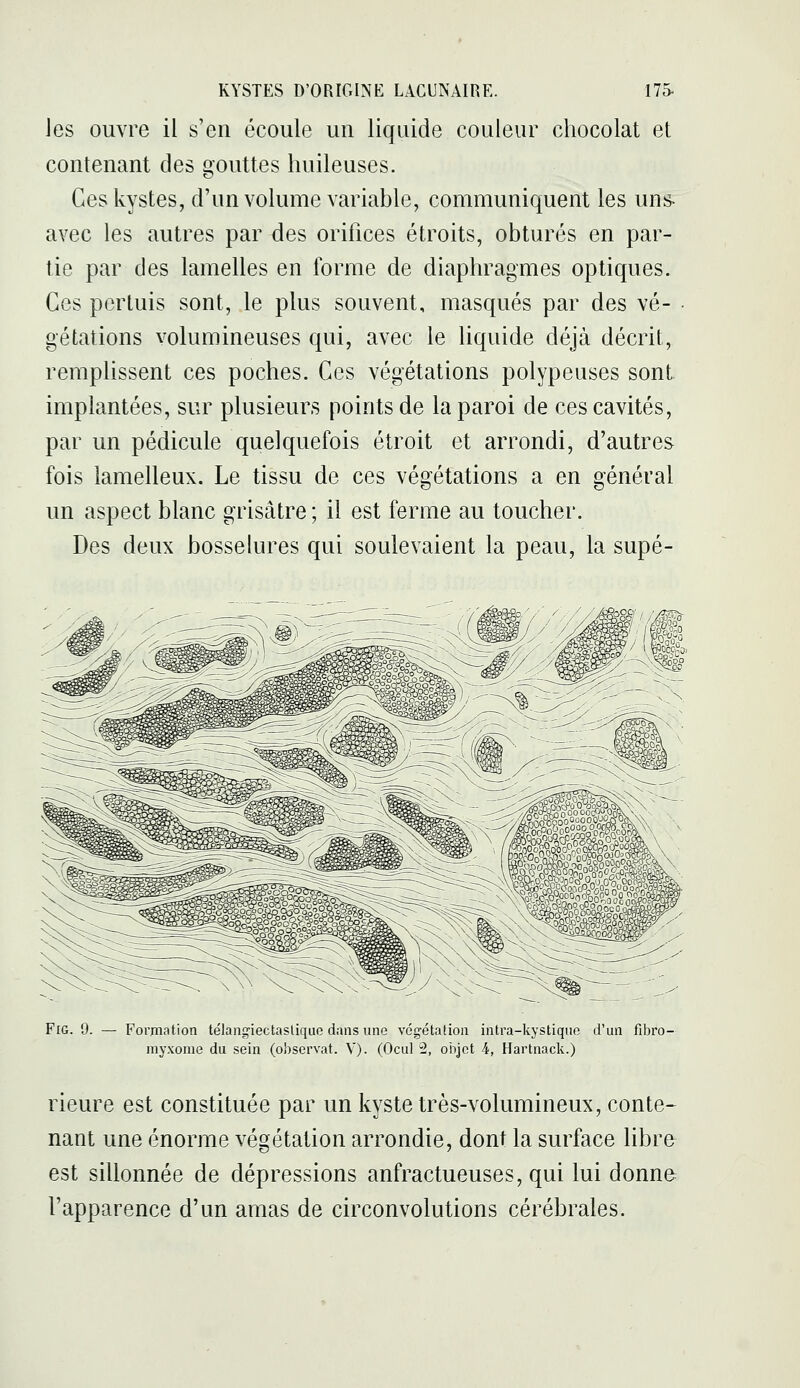 Jes ouvre il s'en écoule un liquide couleur chocolat et contenant des gouttes huileuses. Ces kystes, d'un volume variable, communiquent les uns- avec les autres par des orifices étroits, obturés en par- tie par des lamelles en forme de diaphragmes optiques. Ces pcrtuis sont, le plus souvent, masqués par des vé- gétations volumineuses qui, avec le liquide déjà décrit, remphssent ces poches. Ces végétations polypeuses sont, implantées, sur plusieurs points de la paroi de ces cavités, par un pédicule quelquefois étroit et arrondi, d'autres fois lamelleux. Le tissu de ces végétations a en général un aspect blanc grisâtre ; il est ferme au toucher. Des deux bosselures qui soulevaient la peau, la supé- FlG. 9. — Formation télangiectaslique dans une végétafion intra-kystique d'un fibro- myxome du sein (observât. V). (Ocul 2, objet 4, Hartnack.) rieure est constituée par un kyste très-volumineux, conte- nant une énorme végétation arrondie, dont la surface libre est sillonnée de dépressions anfractueuses, qui lui donne l'apparence d'un amas de circonvolutions cérébrales.