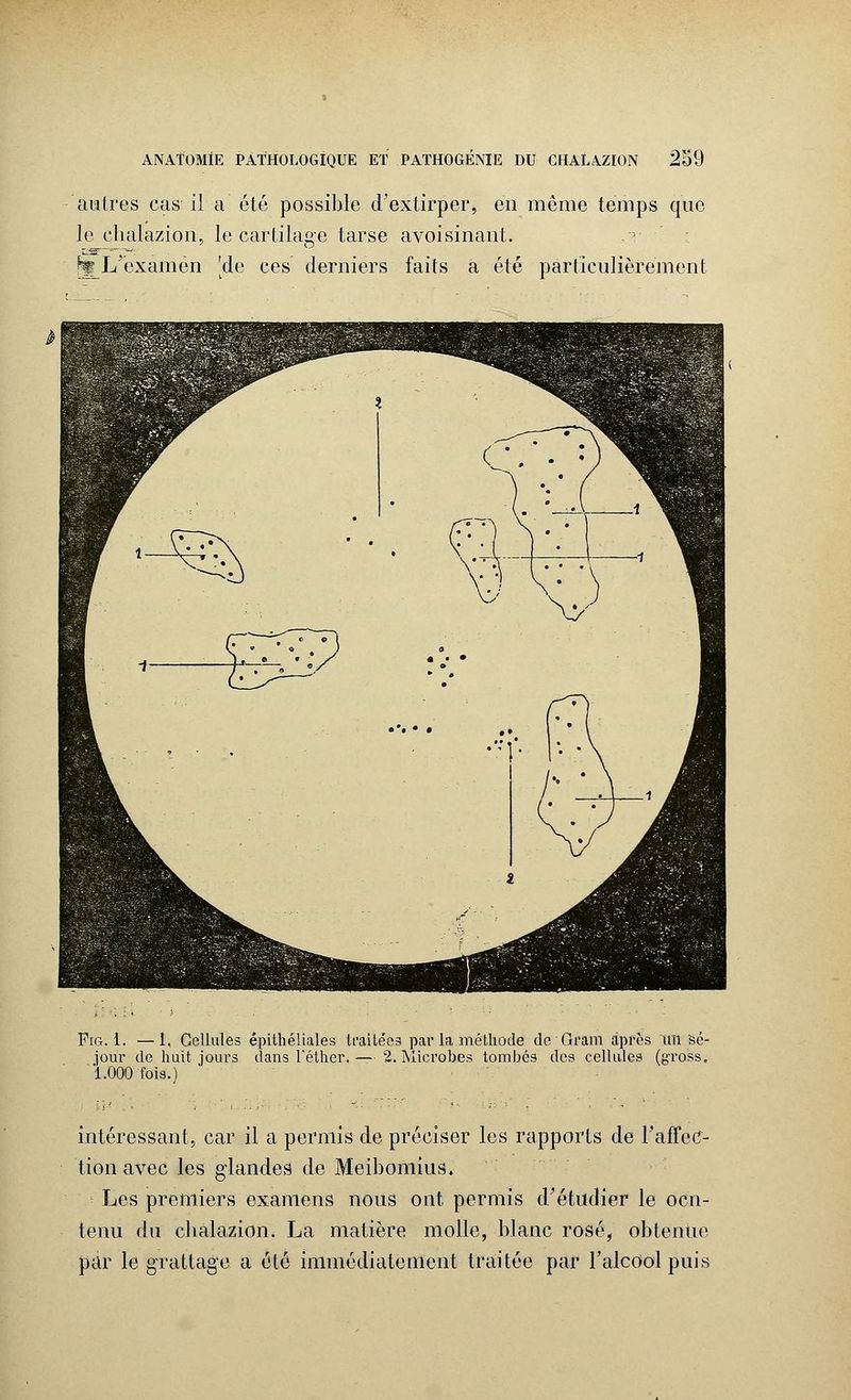autres cas il a été possible d'extirper, en même temps que le chalazion, le cartilage tarse avoisinant. ^L'examen 'de ces derniers faits a été particulièrement Fia. 1. —i. Cellules épithéliales traitées par la méthode de Qram âpres Itîi Sé- jour de huit jours dans Téther.— 2. Microbes tombés des cellules (gro'ss. 1.000 fois.) intéressant, car il a permis de préciser les rapports de F affec- tion avec les glandes de Meibomius. Les premiers examens nous ont permis d'étudier le oen- tenu du chalazion* La matière molle, blanc rosé, obtenue par le grattage a été immédiatement traitée par l'alcool puis