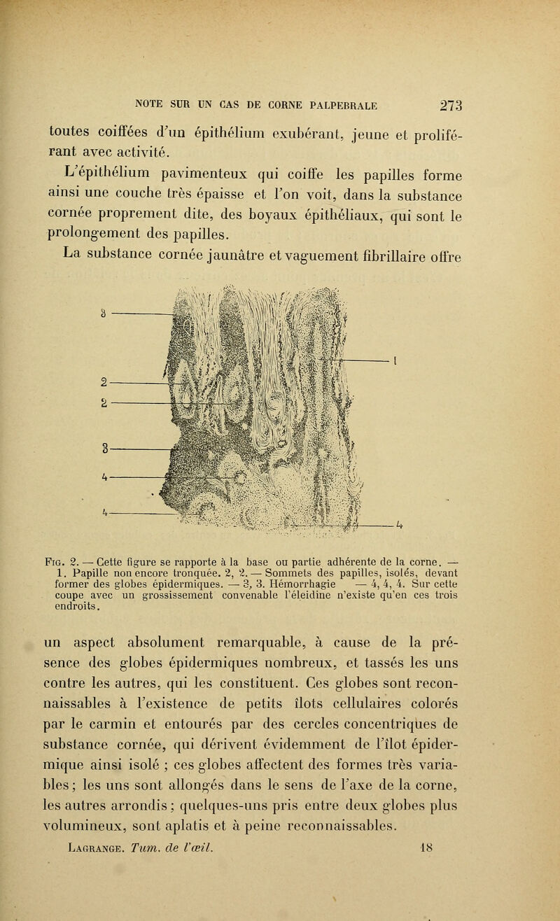 toutes coiffées d'un épithélium exubérant, jeune et prolifé- rant avec activité. L'épithélium pavimenteux qui coiffe les papilles forme ainsi une couche très épaisse et l'on voit, dans la substance cornée proprement dite, des boyaux épithéliaux, qui sont le prolongement des papilles. La substance cornée jaunâtre et vaguement fîbrillaire offre Fig. 2. — Cette figure se rapporte à la base ou partie adhérente de la corne. — 1. Papille non encore tronquée. 2, 2.— Sommets des papilles, isolés, devant former des globes épidermiques. —• 3, 3. Hémorrhagie — 4, 4, 4. Sur cette coupe avec un grossissement convenable l'éleidine n'existe qu'en ces trois endroits. un aspect absolument remarquable, à cause de la pré- sence des globes épidermiques nombreux, et tassés les uns contre les autres, qui les constituent. Ces globes sont recon- naissables à l'existence de petits îlots cellulaires colorés par le carmin et entourés par des cercles concentriques de substance cornée, qui dérivent évidemment de l'îlot épider- mique ainsi isolé ; ces globes affectent des formes très varia- bles ; les uns sont allongés dans le sens de l'axe de la corne, les autres arrondis ; quelques-uns pris entre deux globes plus volumineux, sont aplatis et à peine reconnaissables. Lagrange. Tum. de l'œil. 18
