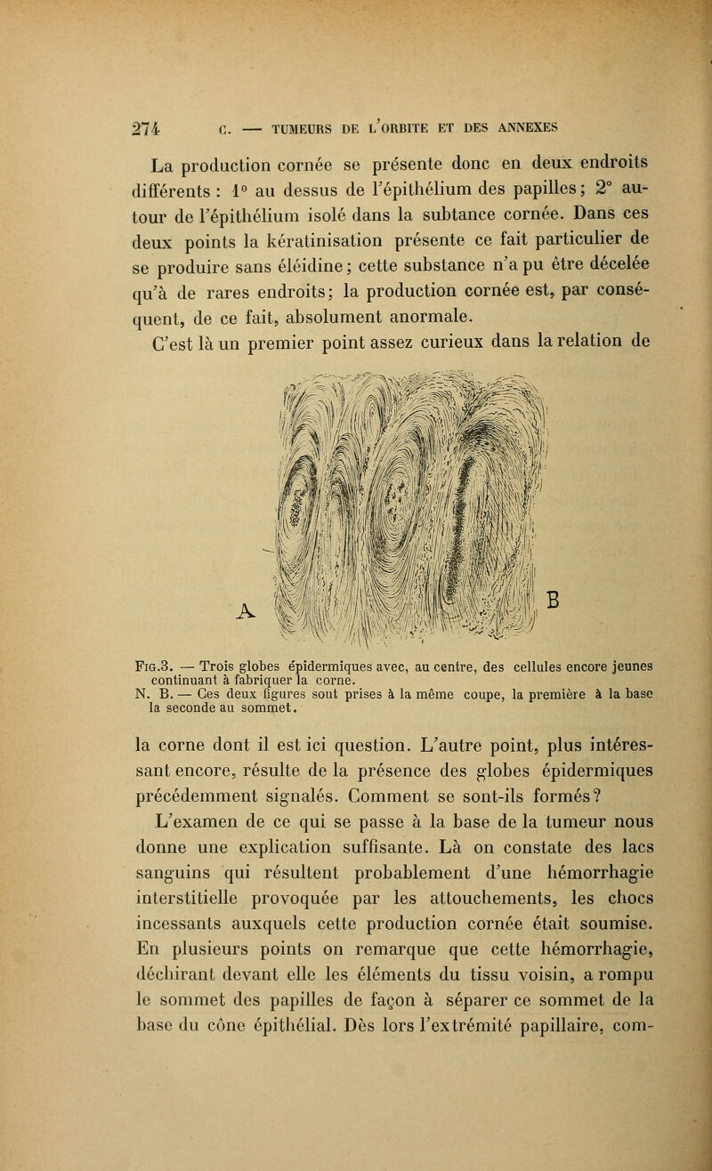 La production cornée se présente donc en deux endroits différents : 1° au dessus de l'épithélium des papilles; 2° au- tour de l'épithélium isolé dans la subtance cornée. Dans ces deux points la kératinisation présente ce fait particulier de se produire sans éléidine ; cette substance n'a pu être décelée qu'à de rares endroits; la production cornée est, par consé- quent, de ce fait, absolument anormale. C'est là un premier point assez curieux dans la relation de ww0wm m éfâ. A Fig.3. — Trois globes épidermiques avec, au centre, des cellules encore jeunes continuant à fabriquer la corne. N. B. — Ces deux figures sont prises à la même coupe, la première à la base la seconde au sommet. la corne dont il est ici question. L'autre point, plus intéres- sant encore, résulte de la présence des globes épidermiques précédemment signalés. Comment se sont-ils formés? L'examen de ce qui se passe à la base de la tumeur nous donne une explication suffisante. Là on constate des lacs sanguins qui résultent probablement d'une hémorrhagie interstitielle provoquée par les attouchements, les chocs incessants auxquels cette production cornée était soumise. En plusieurs points on remarque que cette hémorrhagie, déchirant devant elle les éléments du tissu voisin, a rompu le sommet des papilles de façon à séparer ce sommet de la base du cône épithélial. Dès lors l'extrémité papillaire, com~