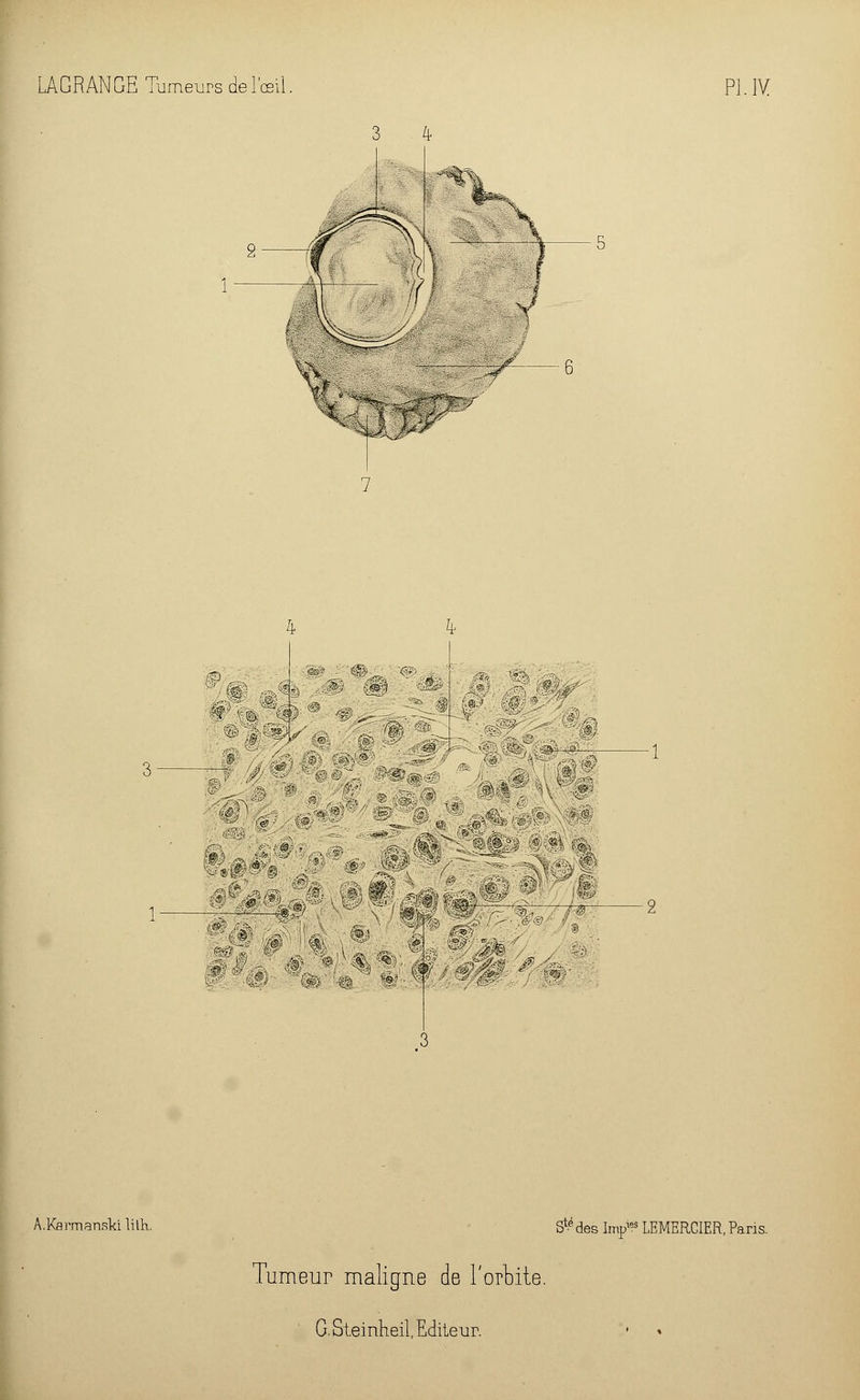 3 4 V ^âj>^ ~^~ m 0!; «m s&i ;^. •%;' *i«' yc—^r- -0M 'U A.Karman.skilith. S1? des Impies LEMERCIER, Paris. Tumeur maligne de l'orbite.