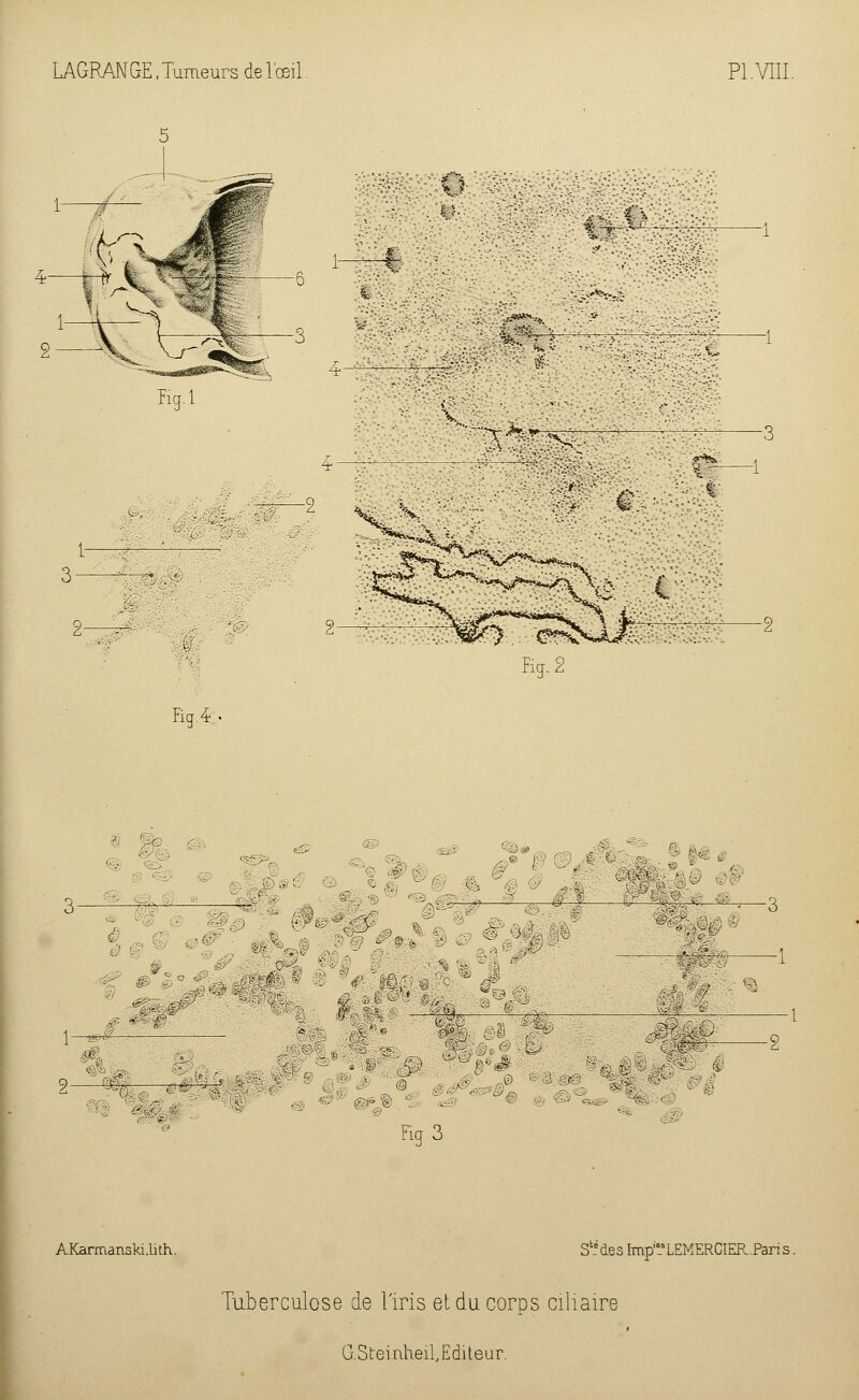 ssé AS V*^:. X Fig.2 Fi g. 4- : -- e& ■'V^iM *:\ s i S; ^r--;. 2 ®% ■ : Fig3 AKarmanski.lith. S1! des ImpiasLEMERClER.Paris. Tuberculose de l'iris et du corps ciliaire G.Steiriheil,Editeur.