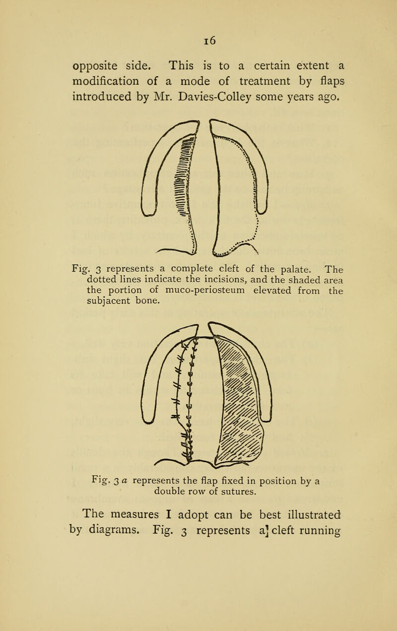 opposite side. This is to a certain extent a modification of a mode of treatment by flaps introduced by Mr. Davies-Colley some years ago. Fig. 3 represents a complete cleft of the palate. The dotted lines indicate the incisions, and the shaded area the portion of muco-periosteum elevated from the subjacent bone. Fii 3 a represents the flap fixed in position by a double row of sutures. The measures I adopt can be best illustrated by diagrams. Fig. 3 represents a] cleft running