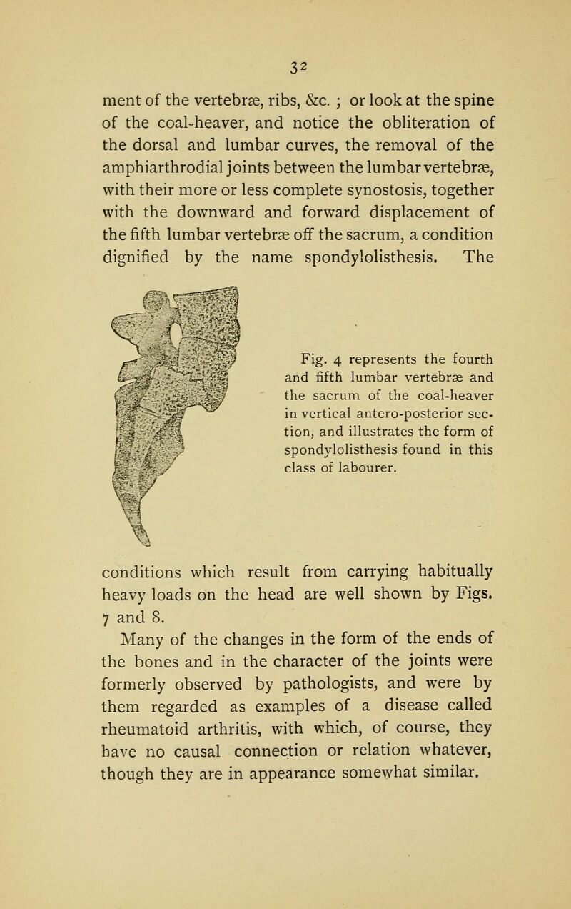 ment of the vertebrae, ribs, &c. ; or look at the spine of the coal-heaver, and notice the obliteration of the dorsal and lumbar curves, the removal of the amphiarthrodial joints between the lumbar vertebrae, with their more or less complete synostosis, together with the downward and forward displacement of the fifth lumbar vertebrae off the sacrum, a condition dignified by the name spondylolisthesis. The Fig. 4 represents the fourth and fifth lumbar vertebrae and the sacrum of the coal-heaver in vertical antero-posterior sec- tion, and illustrates the form of spondylolisthesis found in this class of labourer. conditions which result from carrying habitually heavy loads on the head are well shown by Figs. 7 and 8. Many of the changes in the form of the ends of the bones and in the character of the joints were formerly observed by pathologists, and were by them regarded as examples of a disease called rheumatoid arthritis, with which, of course, they have no causal connection or relation whatever, though they are in appearance somewhat similar.