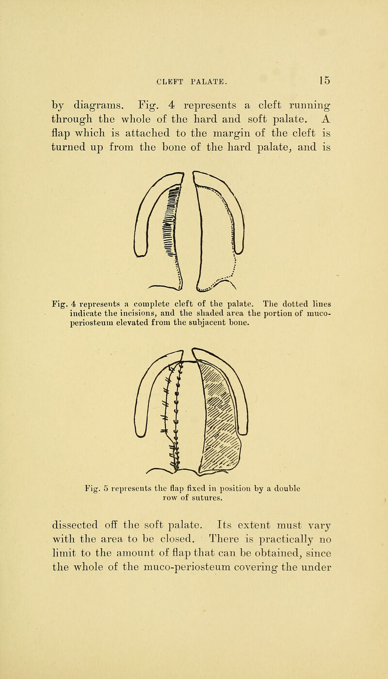 by diagrams. Fig. 4 represents a cleft running through the whole of the hard and soft palate. A flap which is attached to the margin of the cleft is turned up from the bone of the hard palate^ and is Fig. 4 represents a complete cleft of the palate. The dotted lines indicate the incisions, and the shaded area the portion of muco- periosteum elevated from the subjacent bone. Fig. 5 represents the flap fixed in position by a double row of sutures. dissected off the soft palate. Its extent must vary with the area to be closed. There is practically no limit to the amount of flap that can be obtained^ since the whole of the muco-periosteum covering the under