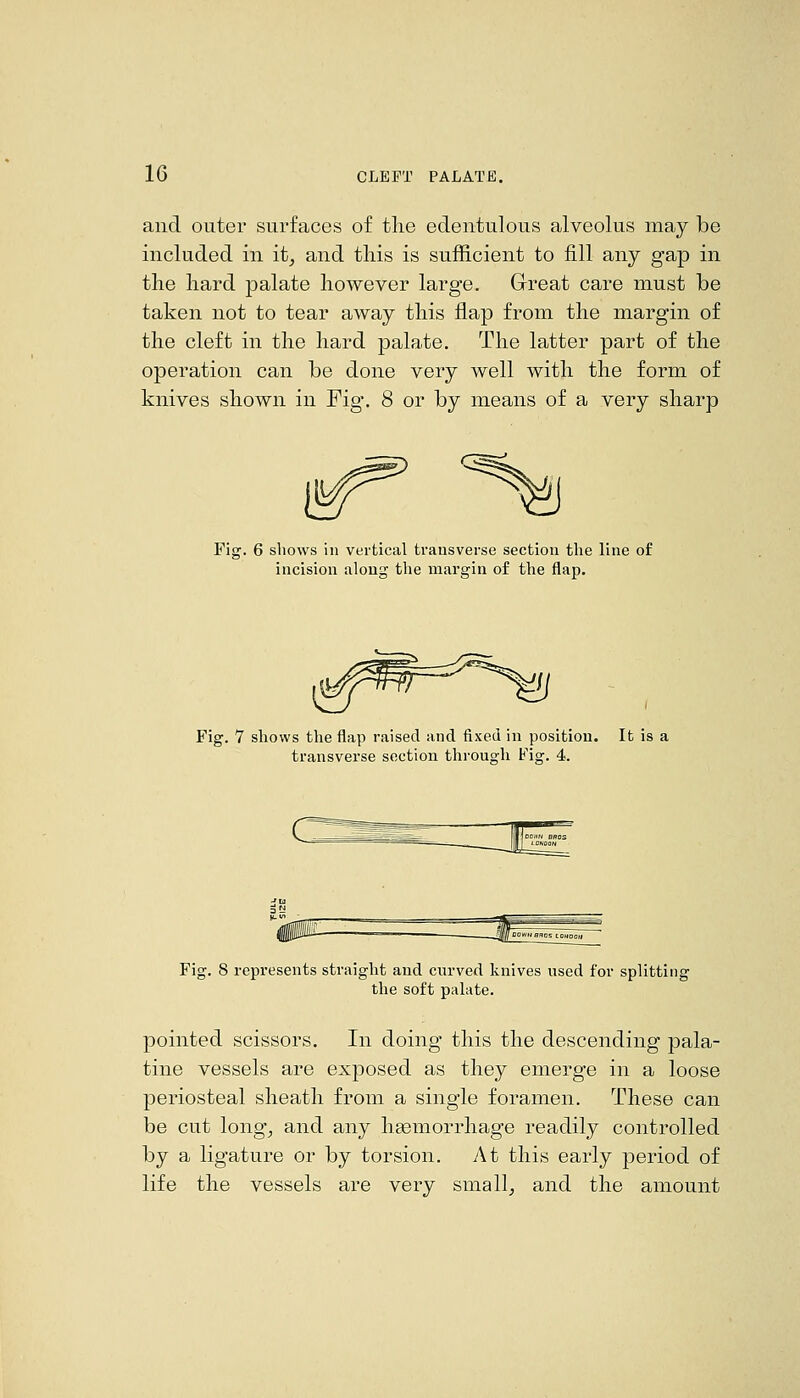 and outer surfaces of the edentulous alveolus may be included in it, and this is sufficient to fill any gap in the hard palate however large. Great care must be taken not to tear away this flap from the margin of the cleft in the hard palate. The latter part of the operation can be done very well with the form of knives shown in Fig-. 8 or by means of a very sharp Fis 6 shows in vertical transverse section the line of incision along the margin of the flap. Fig. 7 shows the flap raised and fixed in position. It is a transverse section through Fig. 4. Fig. 8 represents straight and curved knives used for splitting the soft palate. pointed scissors. In doing this the descending pala- tine vessels are exposed as they emerge in a loose periosteal sheath from a single foramen. These can be cut long, and any heemorrhage readily controlled by a ligature or by torsion. At this early period of life the vessels are very small, and the amount