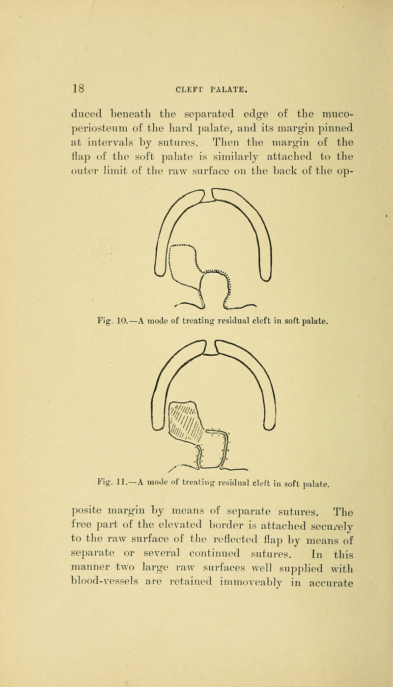 ducecl beneatli the sepai^ated edge of the muco- periosteum of the hard palate^ and its margin pinned at intervals by sutures. Then the margin of the flap of the soft palate is similarly attached to the outer limit of the raw surface on the back of the op- Fig. 10.—A mode of treating residual cleft in soft palate. Fig. 11.—A mode of treating residual cleft in soft palate. posite margin by means of separate sutures. The free part of the elevated border is attached secui-ely to the raw surface of the reflected flap by means of separate or several continued sutures. In this manner two large raw surfaces well supplied with blood-vessels are retained immoveably in accurate