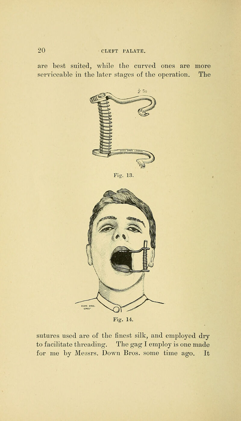 are best suited, while the curved ones are more serviceable in the later stages of the operation. The Fi^. 13. sutures used are of the finest silk, and employed dry to facilitate threading. The gag I employ is one made for me by Messrs. Down Bros, some time ago. It